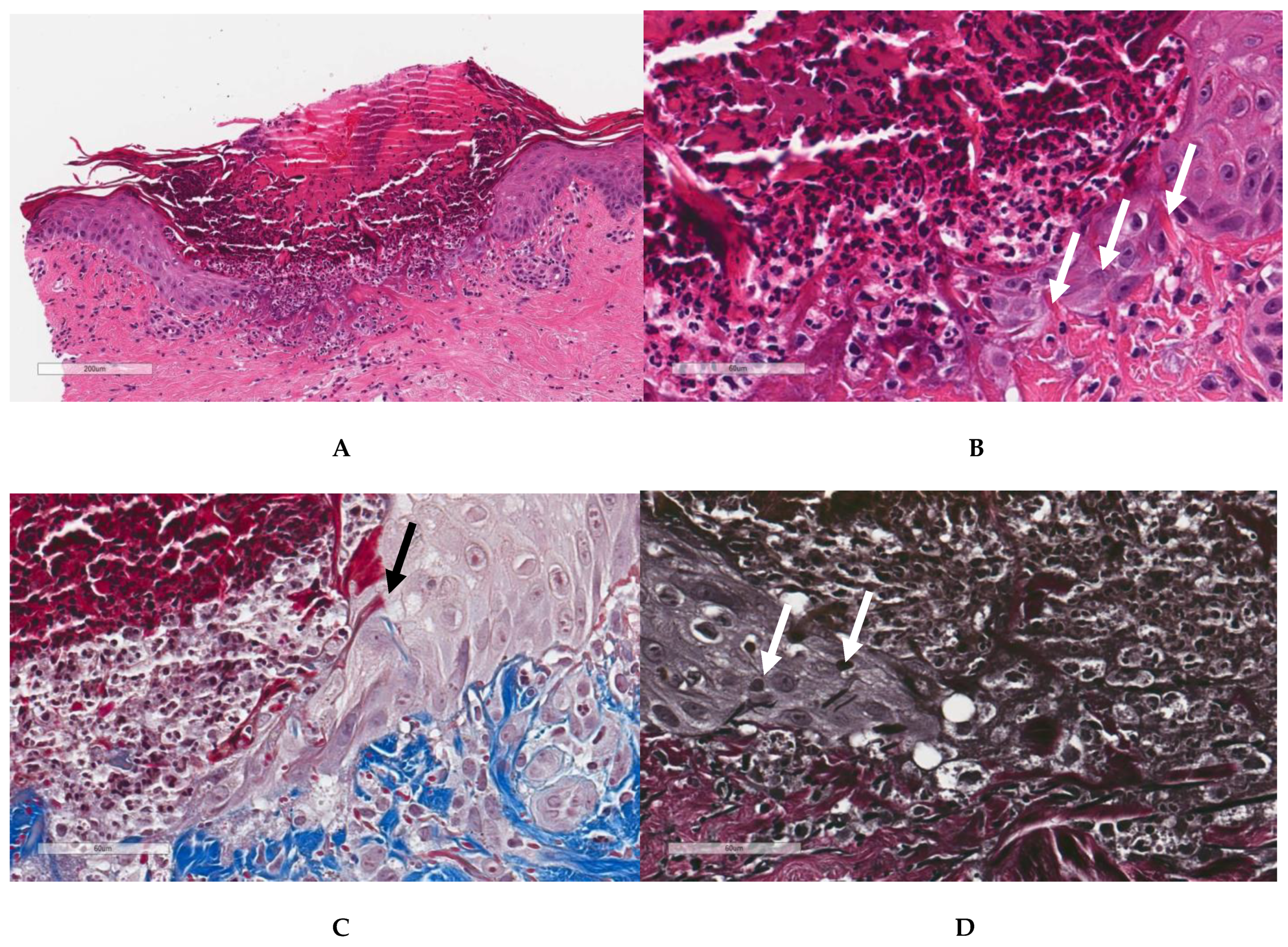 Perforating Gout: Expanding the Differential for Perforating Gout: Expanding the Differential for