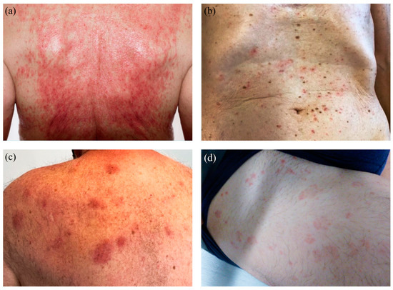 Swollen Lymph Nodes 12 Months After Covid Vaccine Cutaneous Reactions after COVID-19 Vaccines: Analysis of the Clinical