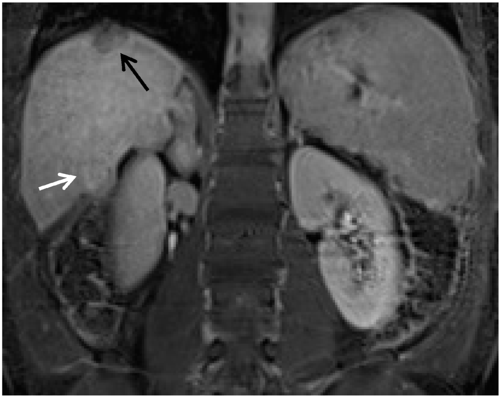 Contrast Enhanced MRI in the Diagnosis of HCC