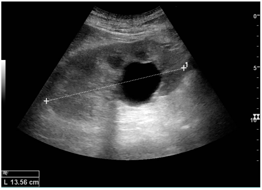 Kidney Tumor Ultrasound