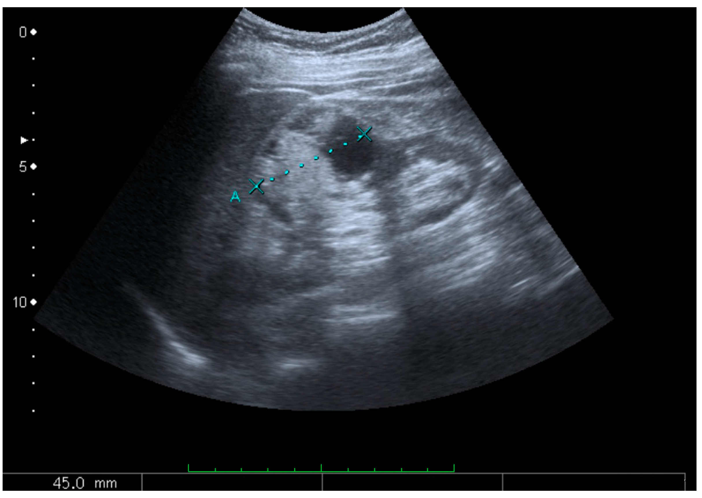 Kidney Tumor Ultrasound