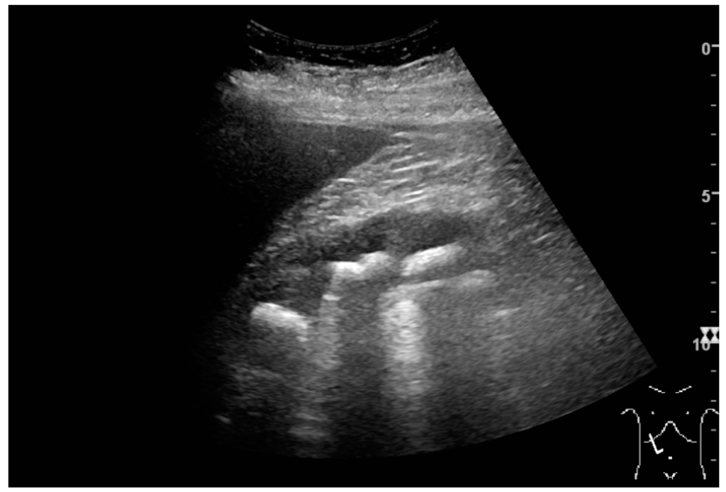 Ultrasonography of the Kidney: A Pictorial Review