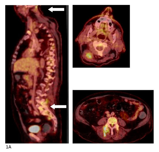 Staphylococcus aureus Bacteremia from Diffuse Muscular Infection ...