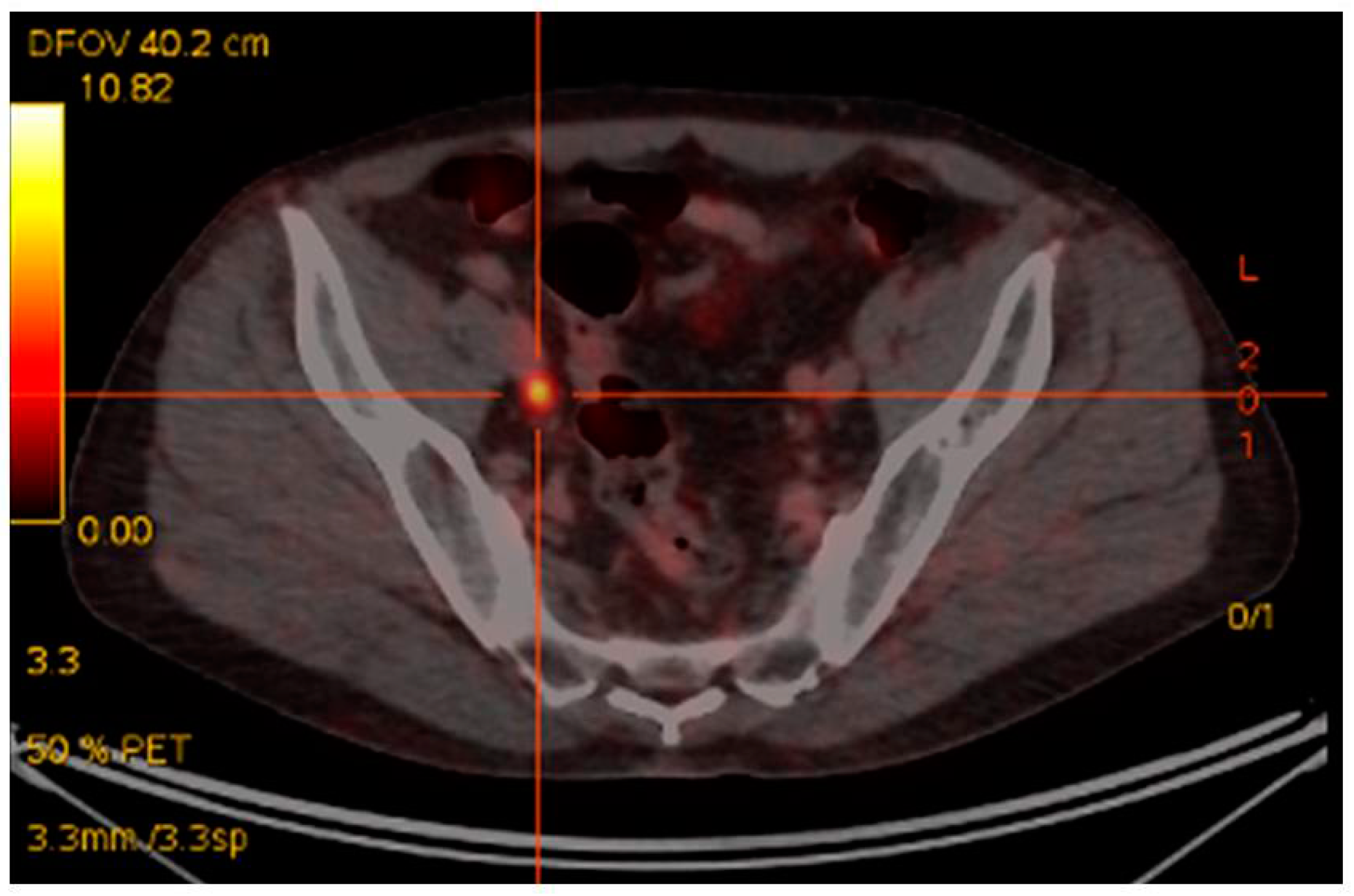 how long is lupron effective for prostate cancer