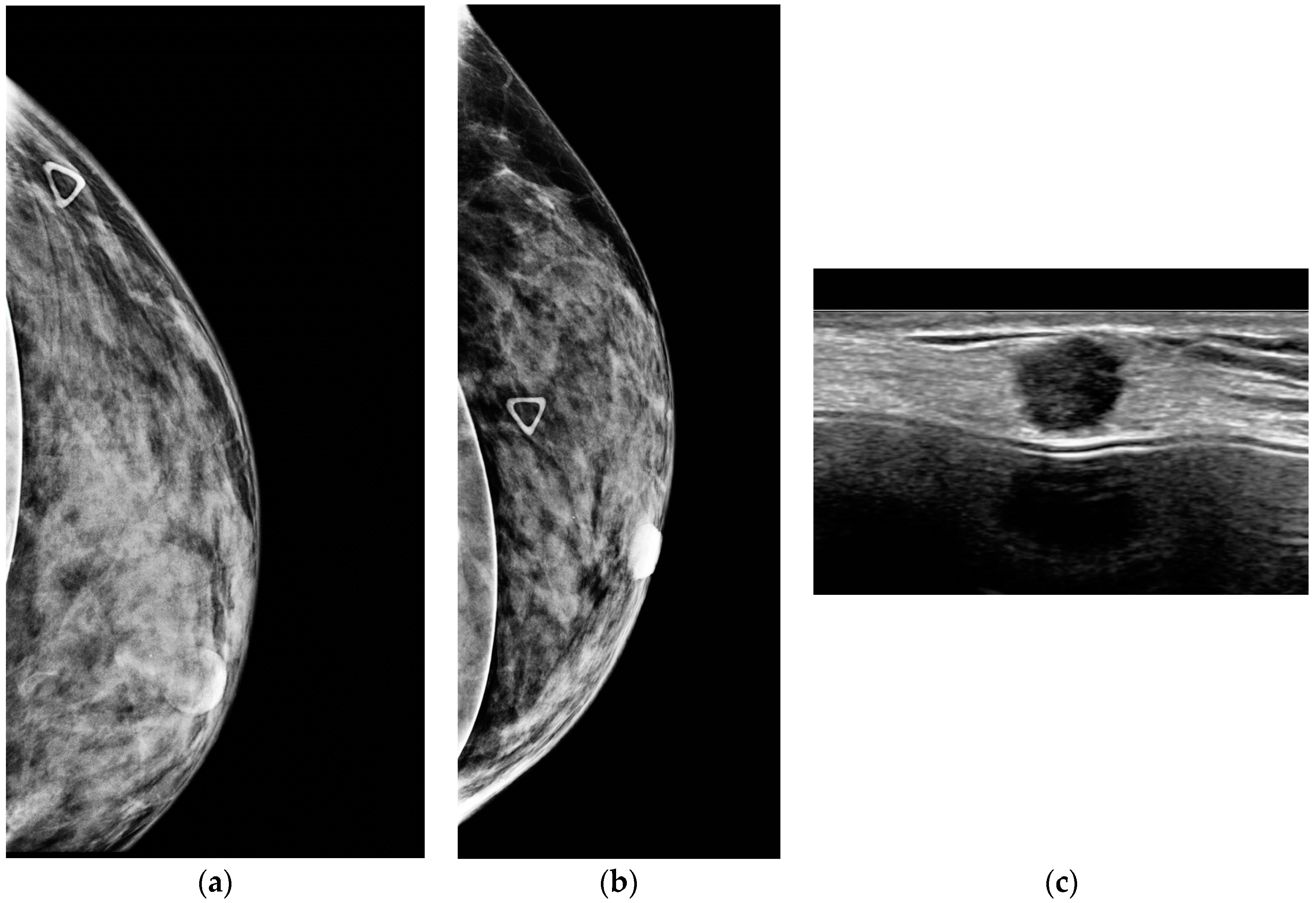 Diagnostics Free Full Text The Role Of Ultrasound In Screening Dense Breasts A Review Of The Literature And Practical Solutions For Implementation Html Diagnostics Free Full Text The Role Of Ultrasound In Screening Dense Breasts A Review Of The Literature And Practical Solutions For Implementation Html