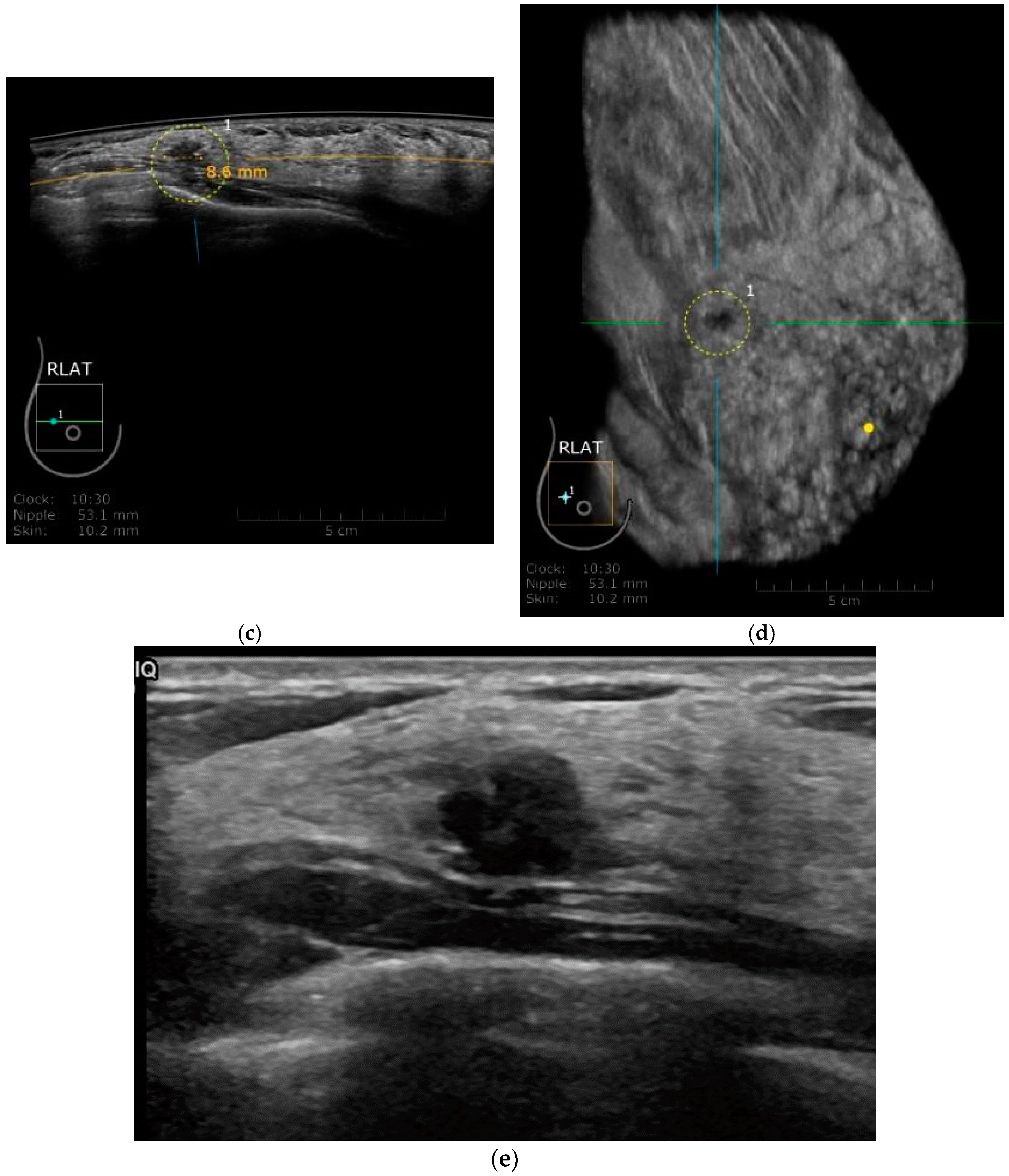 Diagnostics Free Full Text The Role Of Ultrasound In Screening Dense Breasts A Review Of The Literature And Practical Solutions For Implementation Html