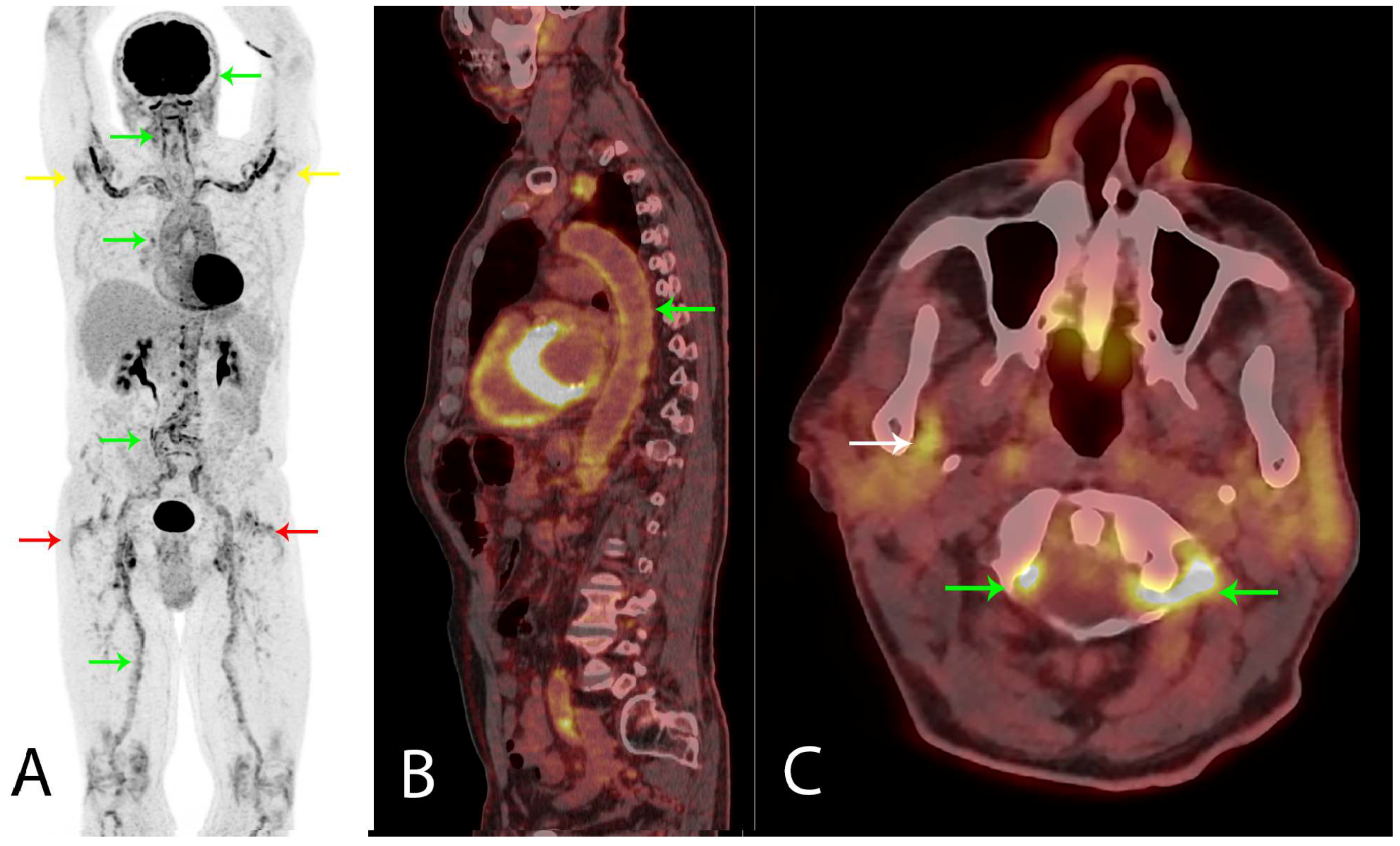vasculitis-as-related-to-polymyalgia-rheumatica-pictures