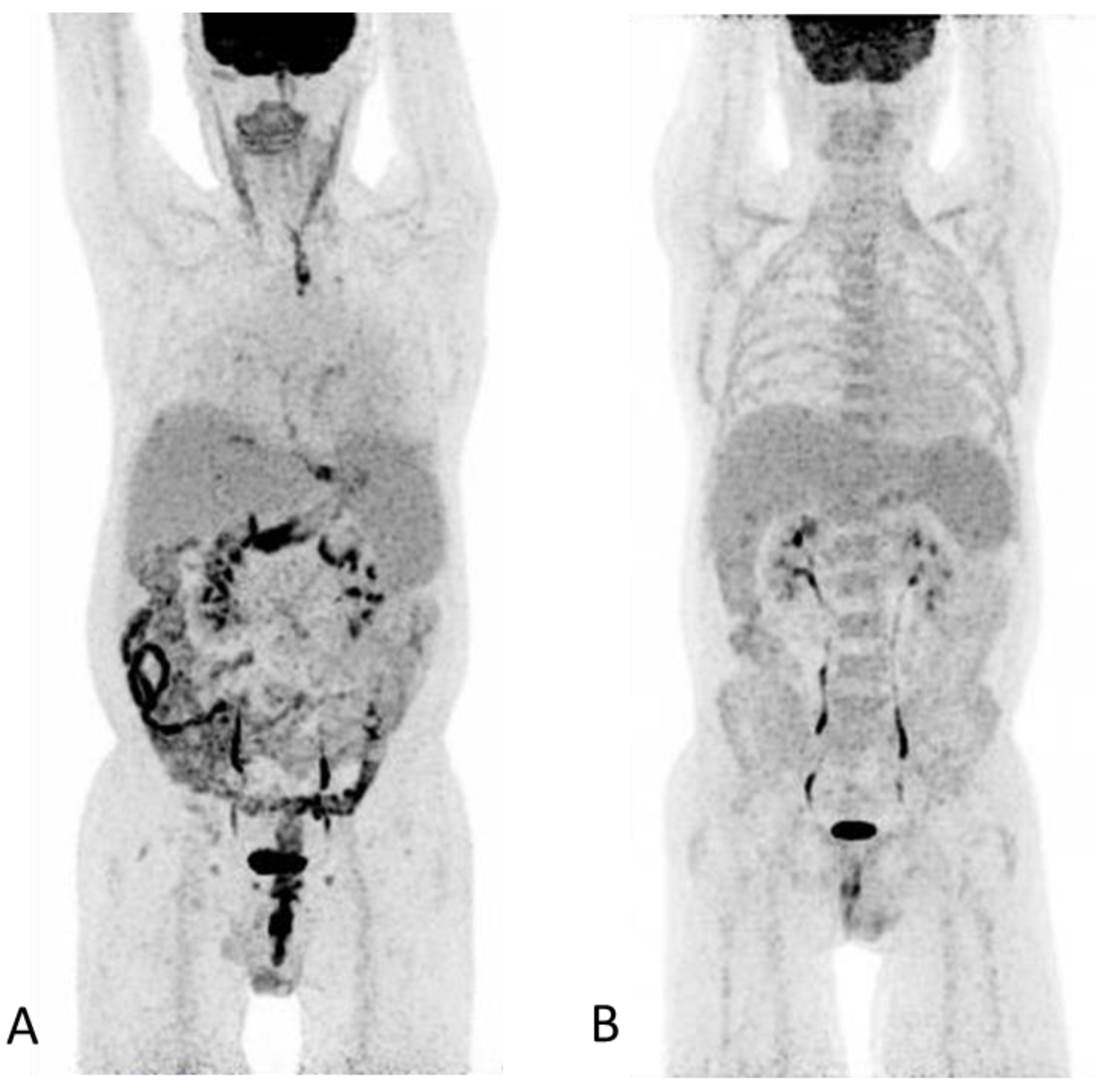 Diagnostics Free Full Text 18 F Fdg Pet Ct In Extensive Graft Versus Host Disease Of The Gastrointestinal Tract Following Autologous Stem Cell Transplantation Html Diagnostics Free Full Text 18 F Fdg Pet Ct In Extensive Graft Versus Host Disease Of The Gastrointestinal Tract Following Autologous Stem Cell Transplantation Html