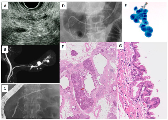 download diagnosing pancreatic cancer