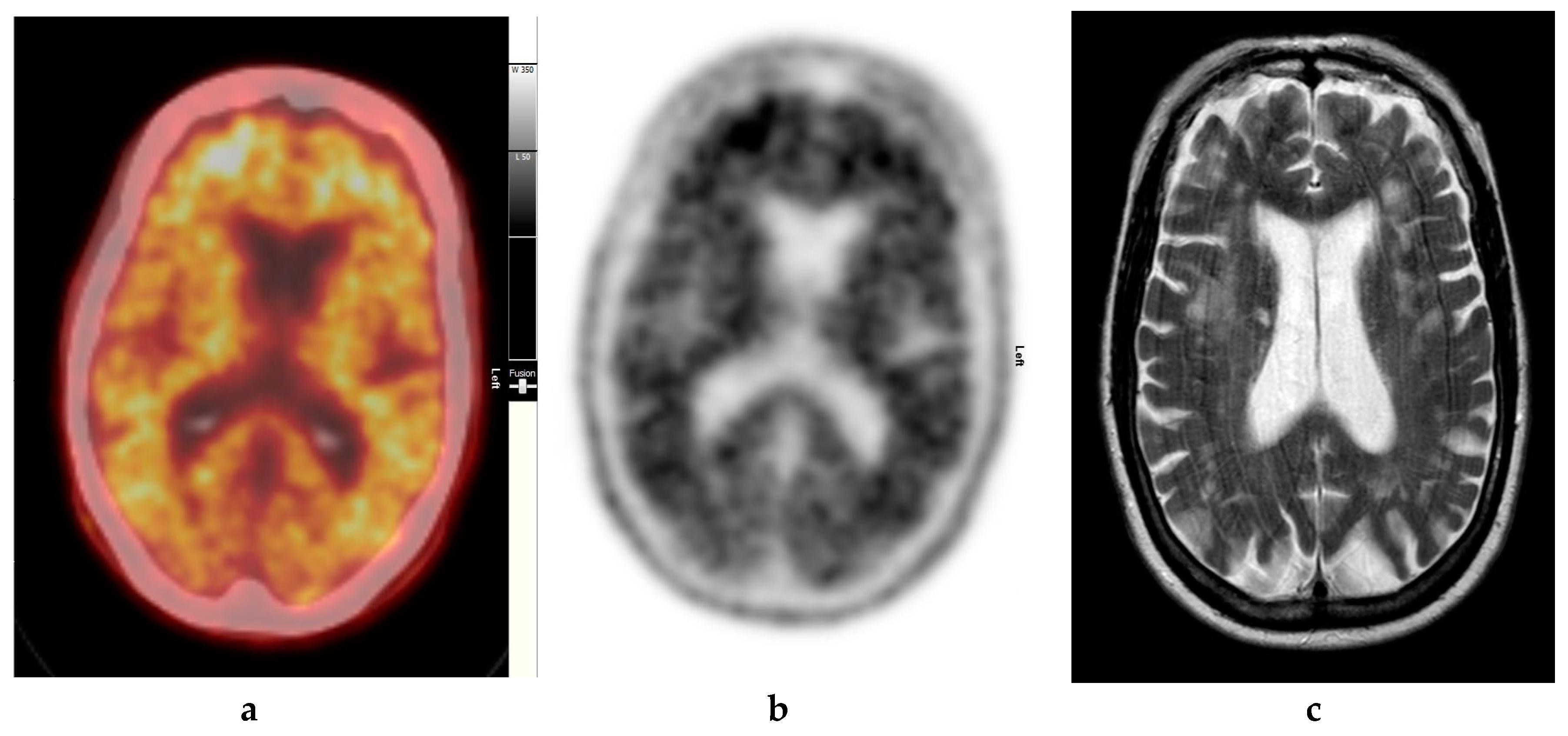 Diagnostics Free Full-Text | The Who, When, Why, and of PET Imaging in Management of Alzheimer's Disease—Review of Literature and Interesting Images