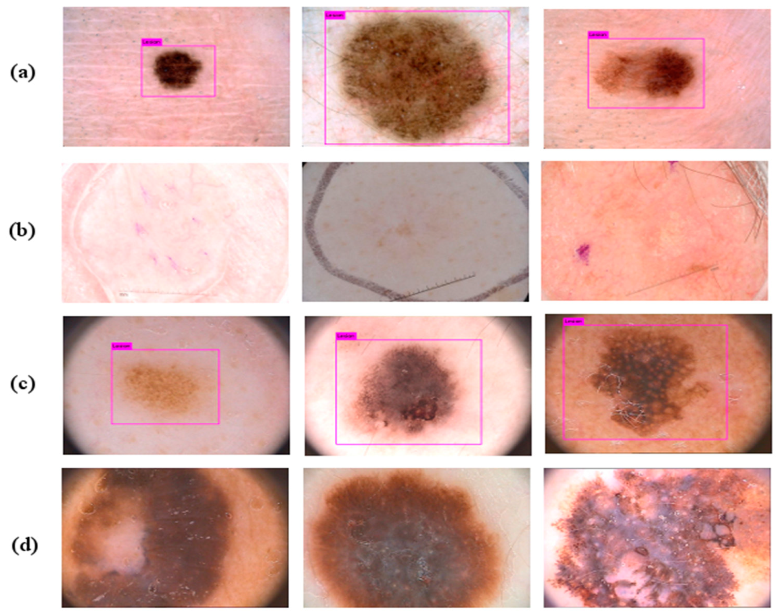 Skin Lesion Chart