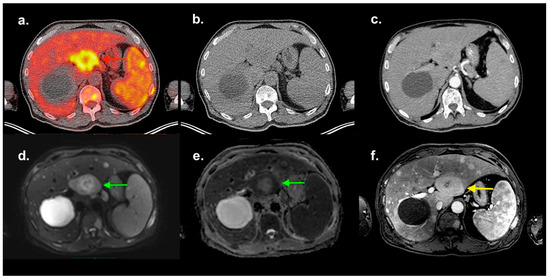 Imaging Features of Multiple Myeloma Extramedullary Lesions in the ...