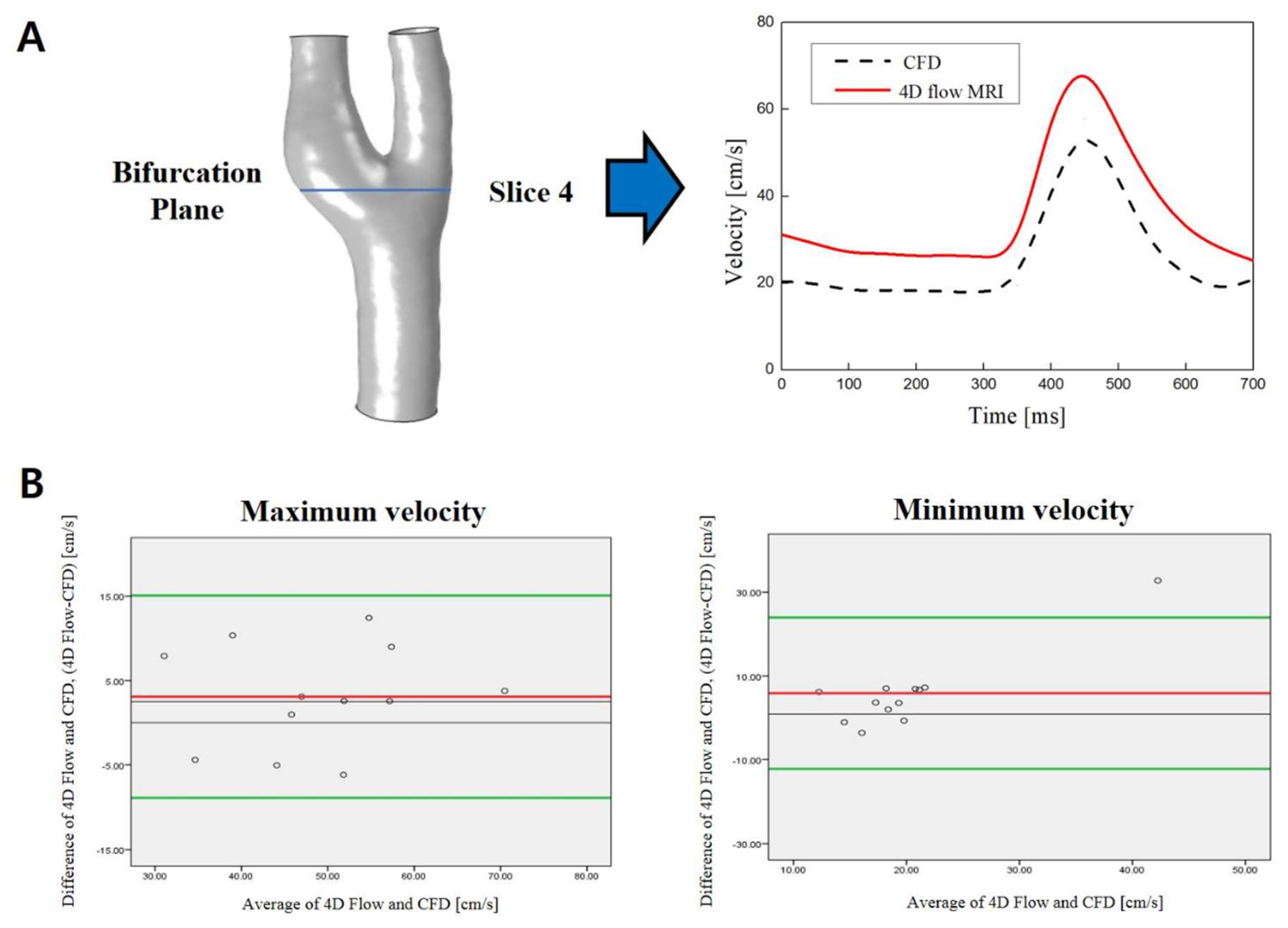 Carotid Ultrasound Velocity Chart