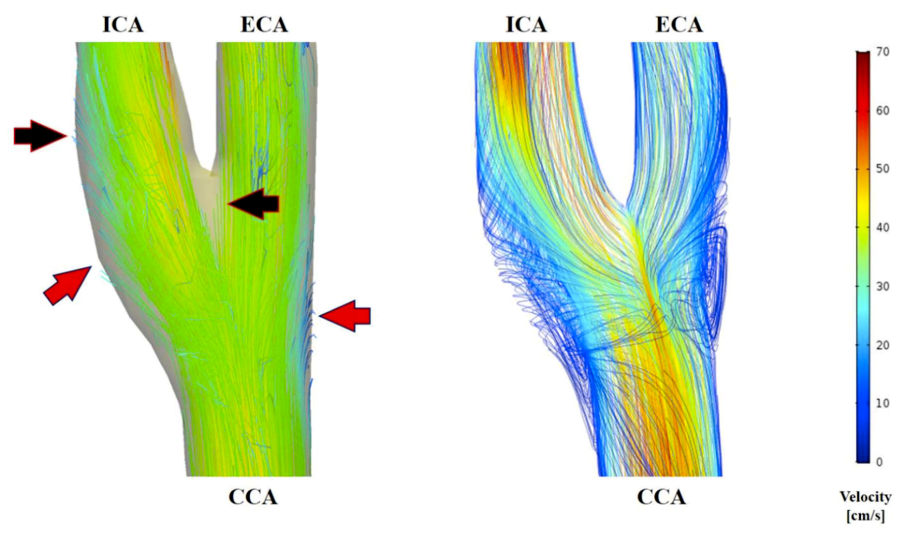 Carotid Ultrasound Velocity Chart