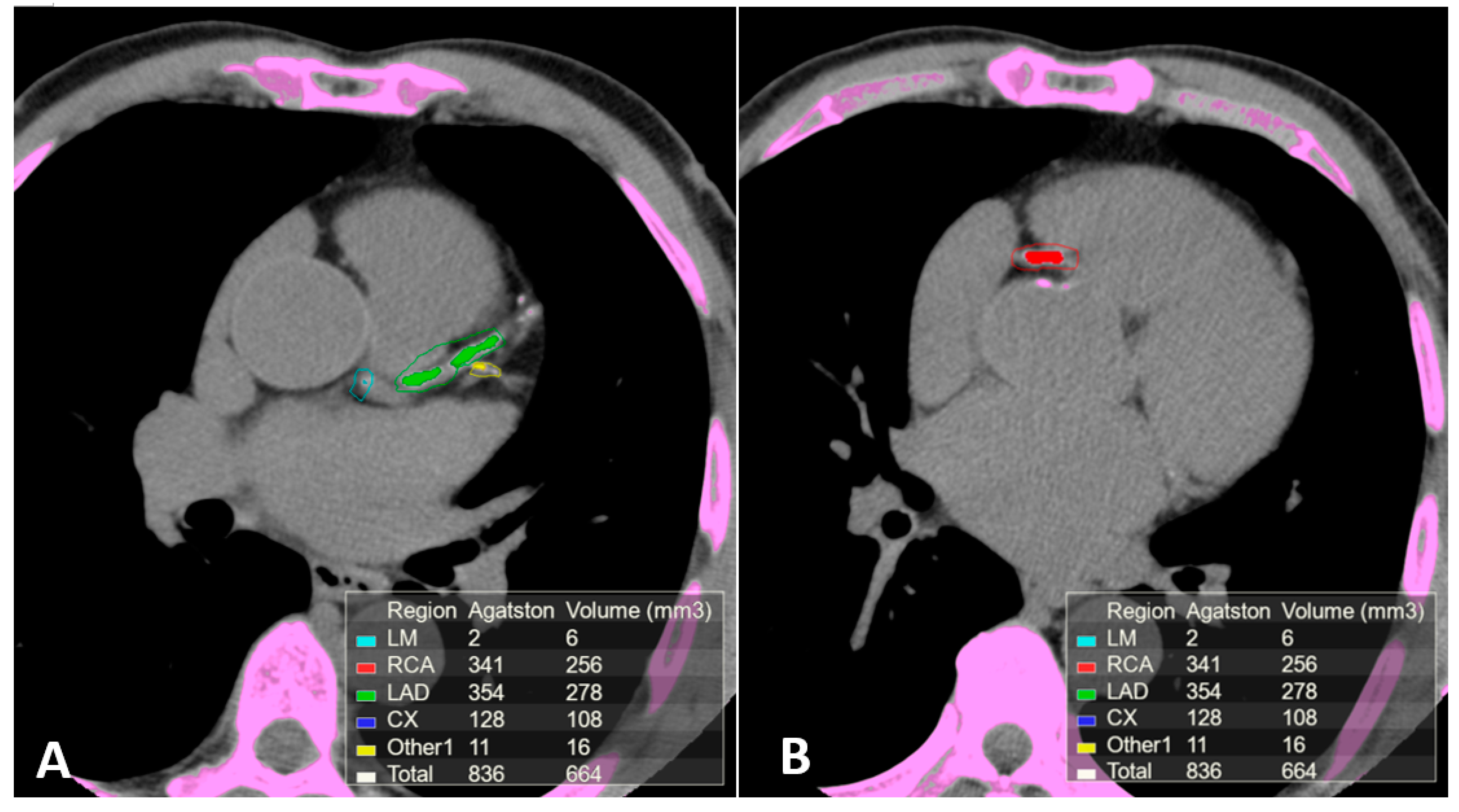 Contrast Media with and without Calcium for Cardioangiography in