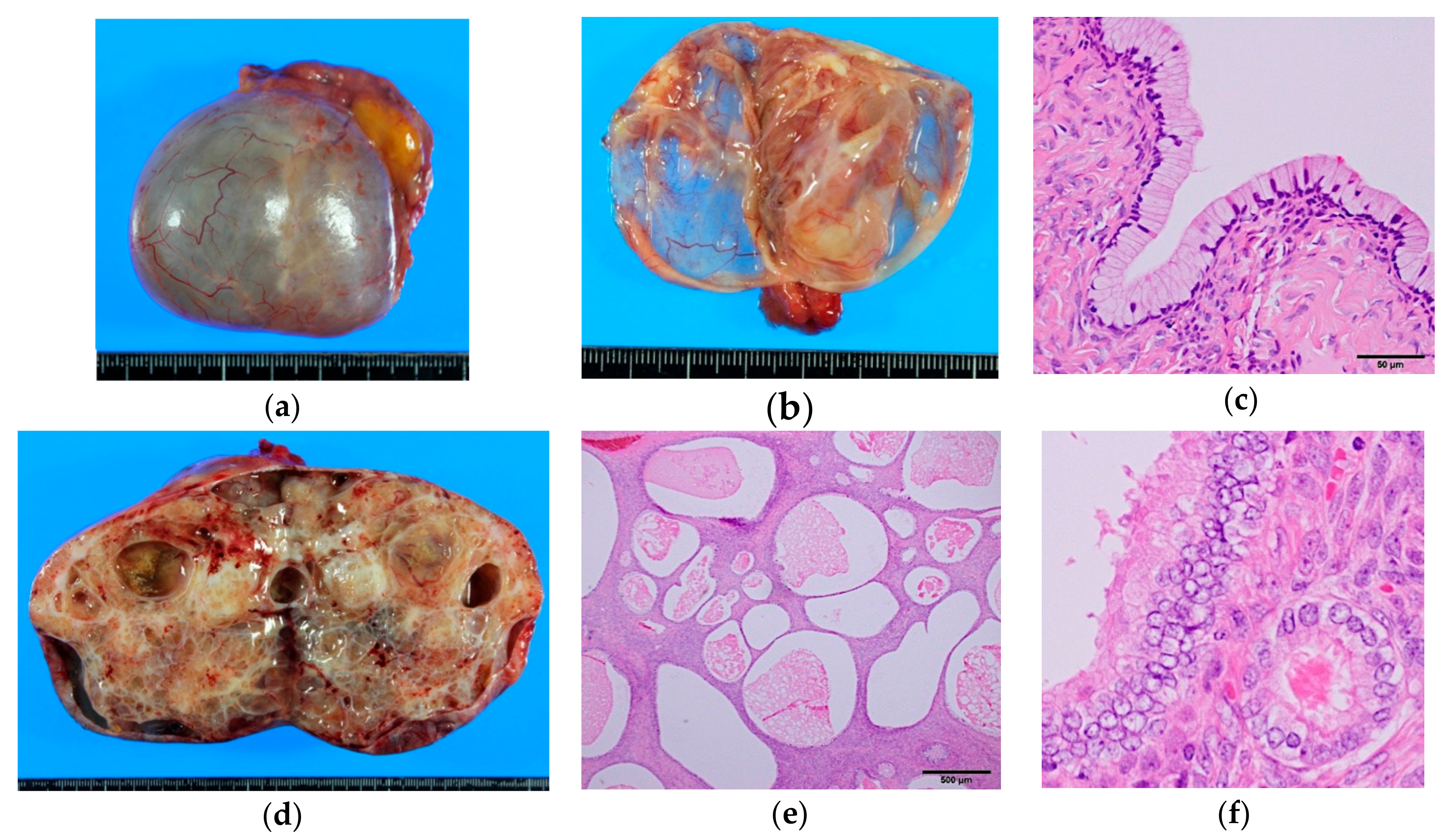 cancer ovarian mucinos)