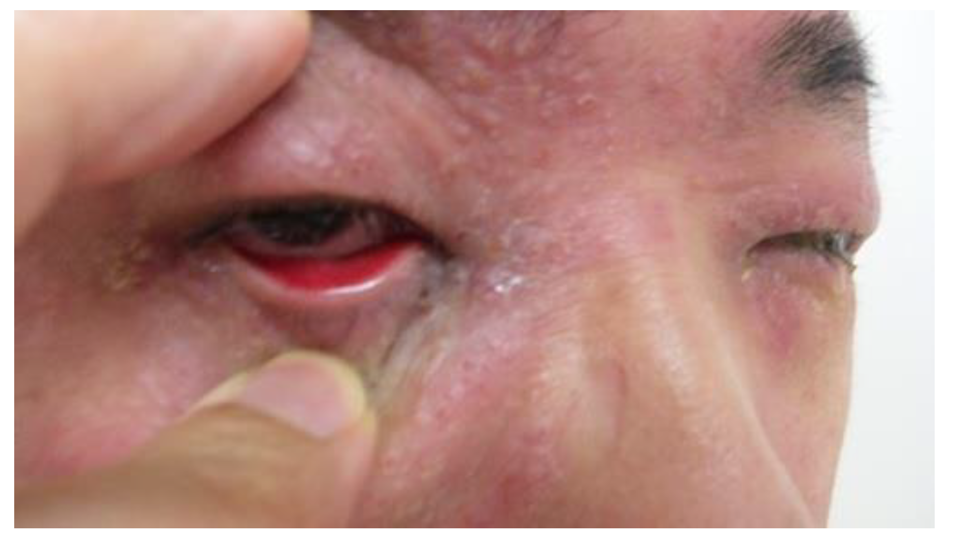 Conjunctival Injection