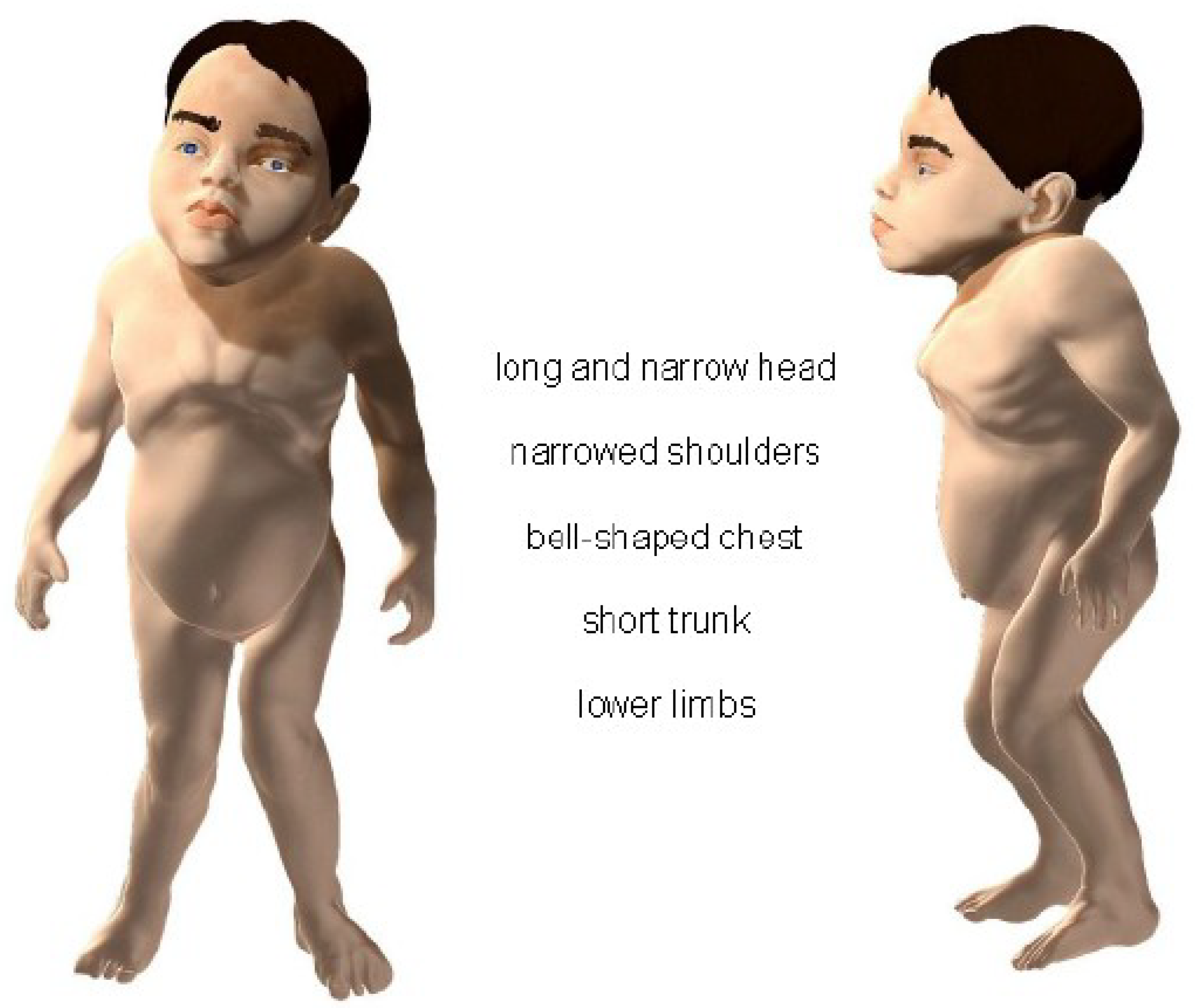 Nursing Paper Example on Morquio Syndrome [SOLVED]