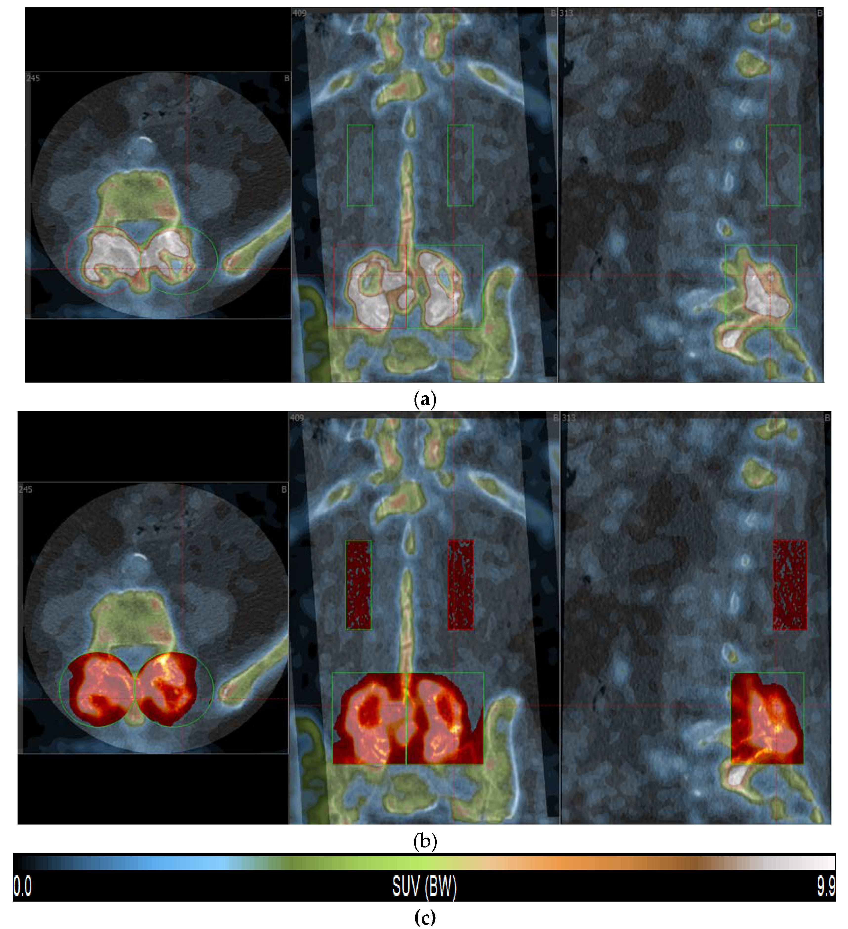 IKE様 Fusion and Healing Prediction in Posterolateral Spinal