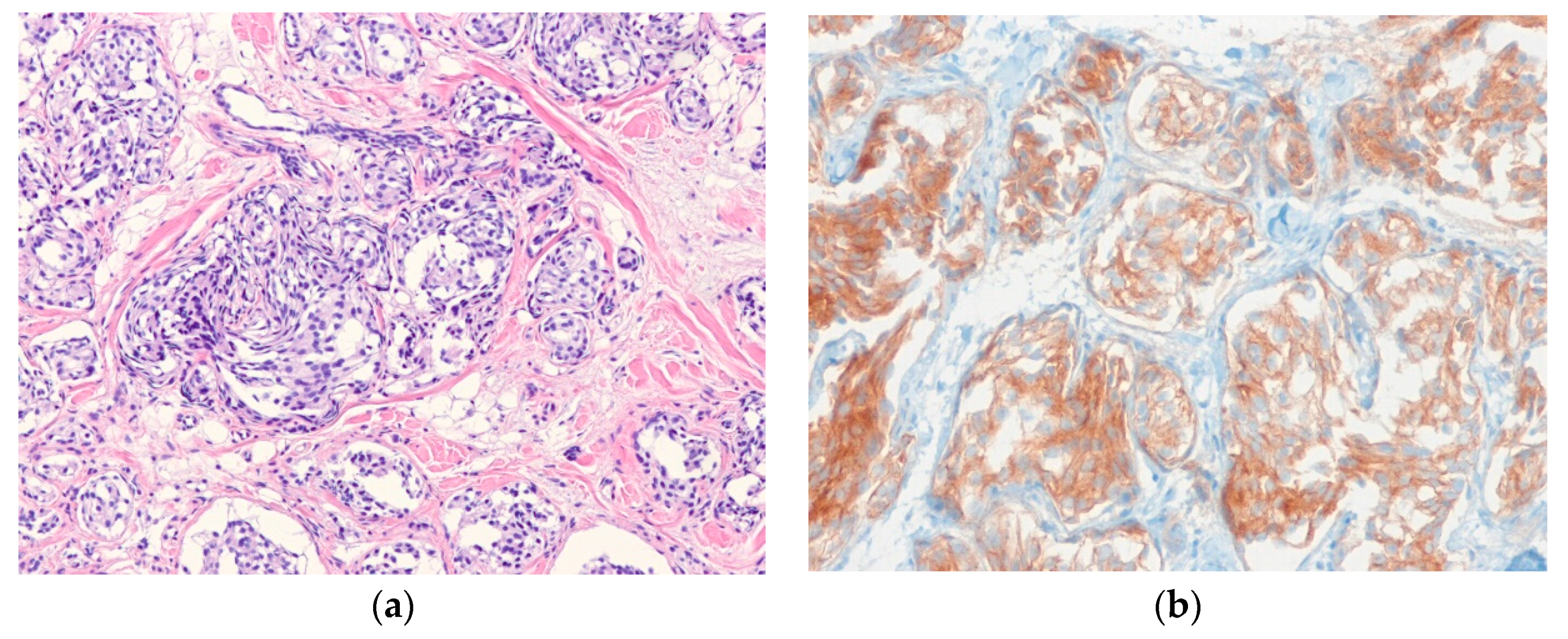 cancer metastasis to brain icd 10