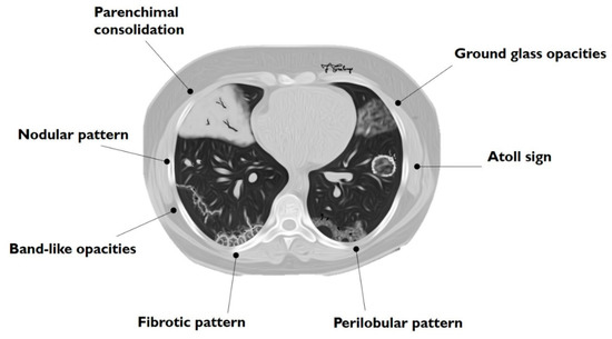 Organizing Pneumonia CT Scan Findings