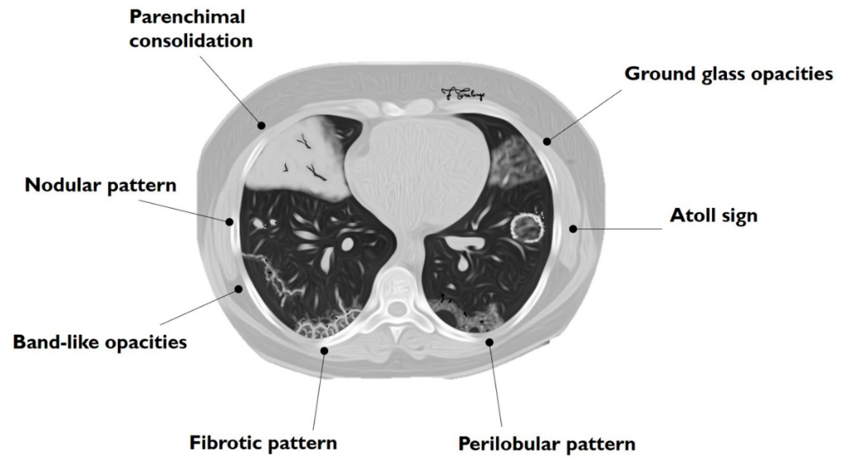 Pneumonia covid organising Organizing Pneumonia