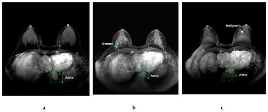 Detection and Diagnosis of Breast Cancer Using Artificial