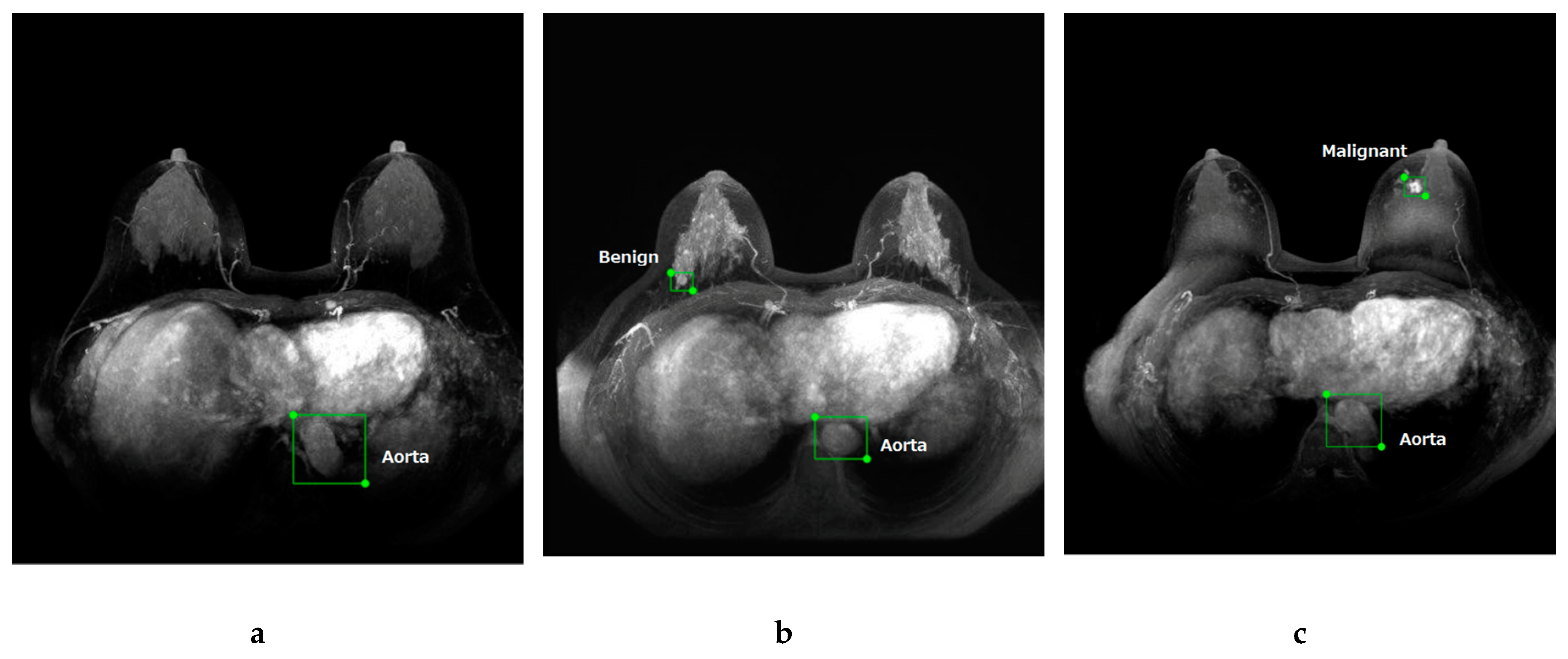Detection and Diagnosis of Breast Cancer Using Artificial