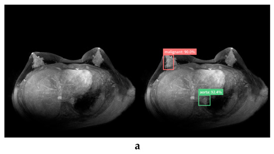 Detection and Diagnosis of Breast Cancer Using Artificial