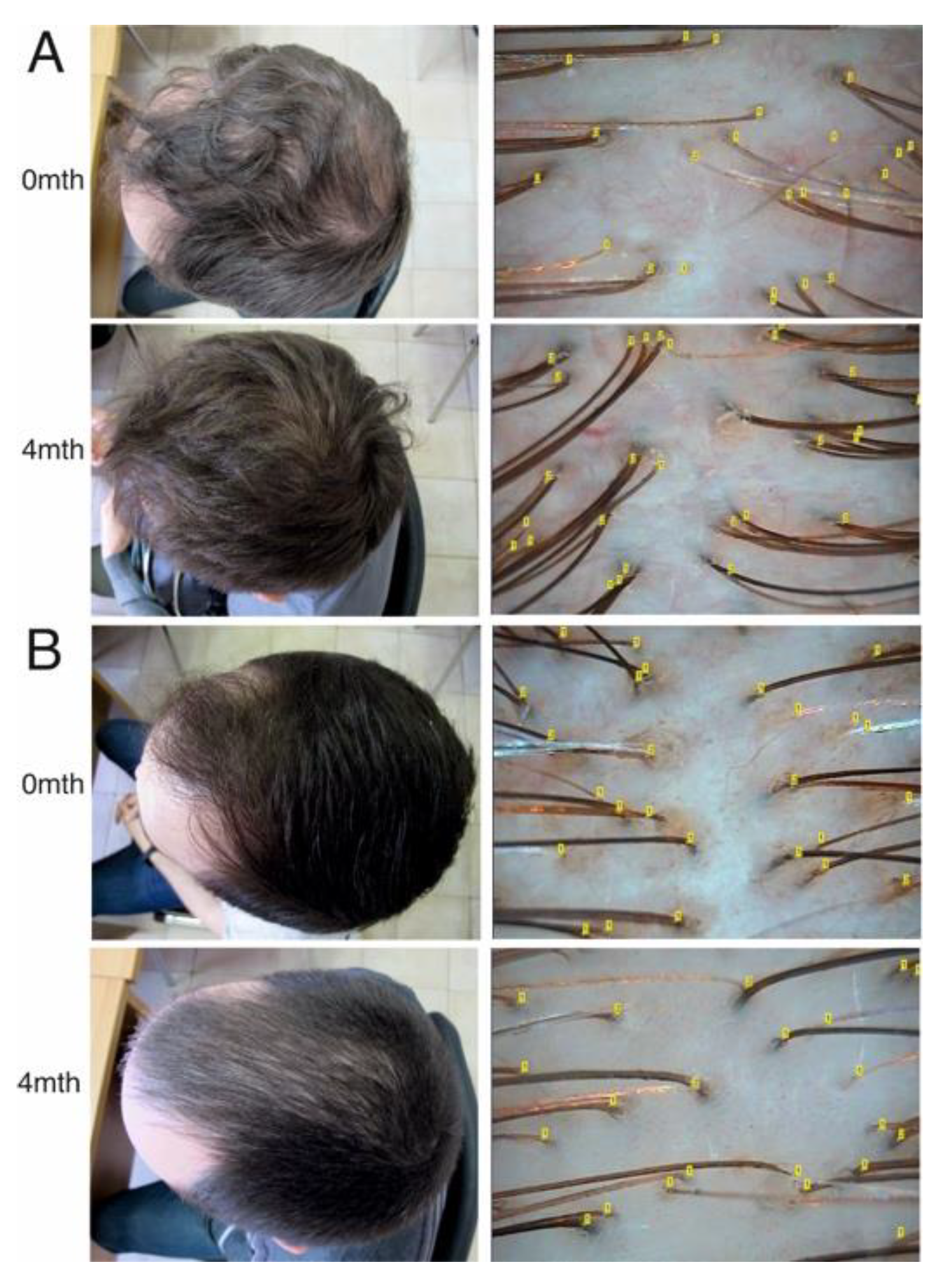 Diagnostics | Free Full-Text | Plasma Zinc Levels in Males with Androgenetic Alopecia as Possible Predictors of the Subsequent Conservative Therapy's Effectiveness Diagnostics | Free Full-Text | Plasma Zinc Levels in Males with Androgenetic Alopecia as Possible Predictors of the Subsequent Conservative Therapy's Effectiveness