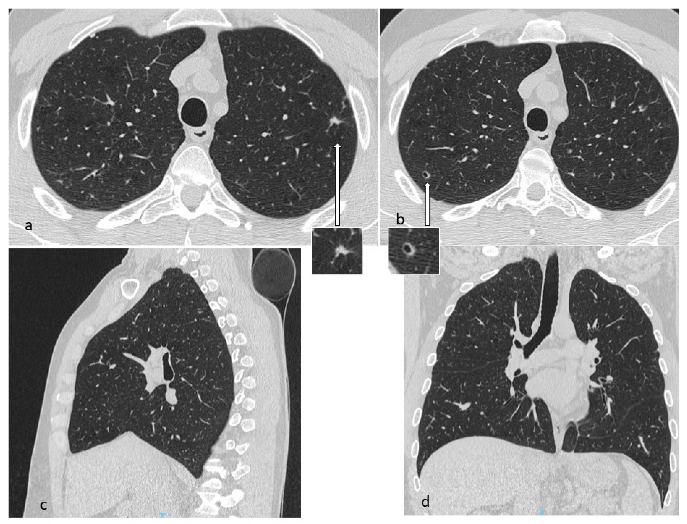 Gross image showing dilated and thick-walled blood vessels with