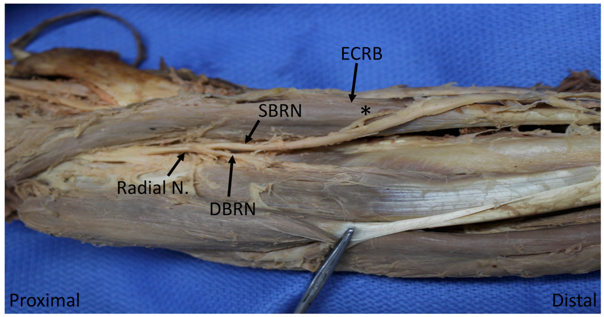 Diagnostics Free Full Text The Branching And Innervation Pattern Of The Radial Nerve In The Forearm Clarifying The Literature And Understanding Variations And Their Clinical Implications Html