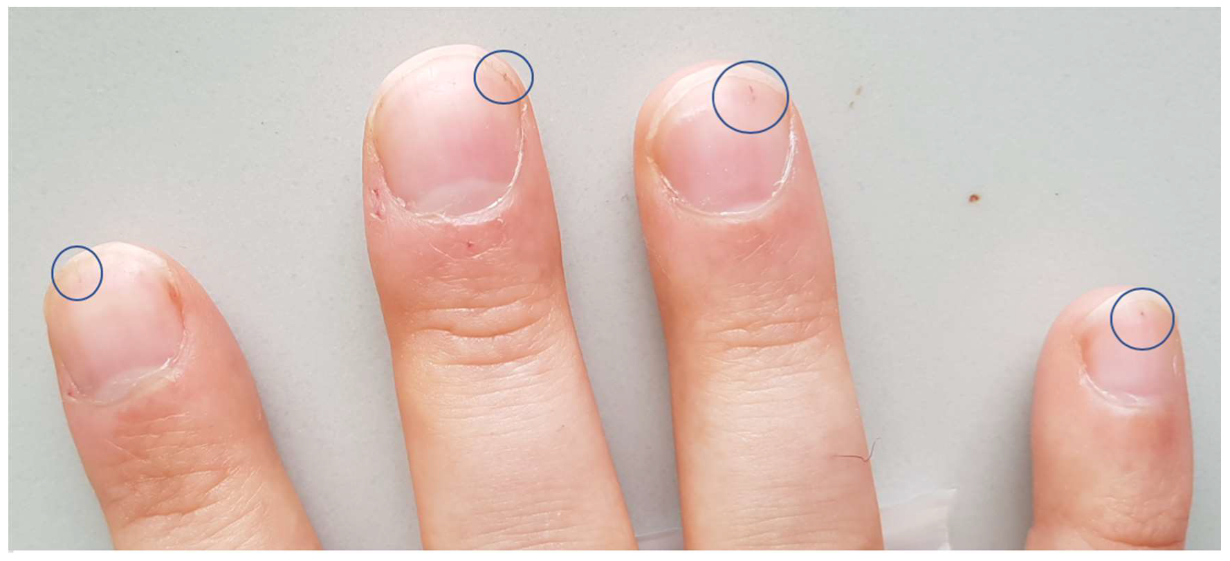 Treating Splinter Hemorrhages (Fingernail Abnormality) - MD.com