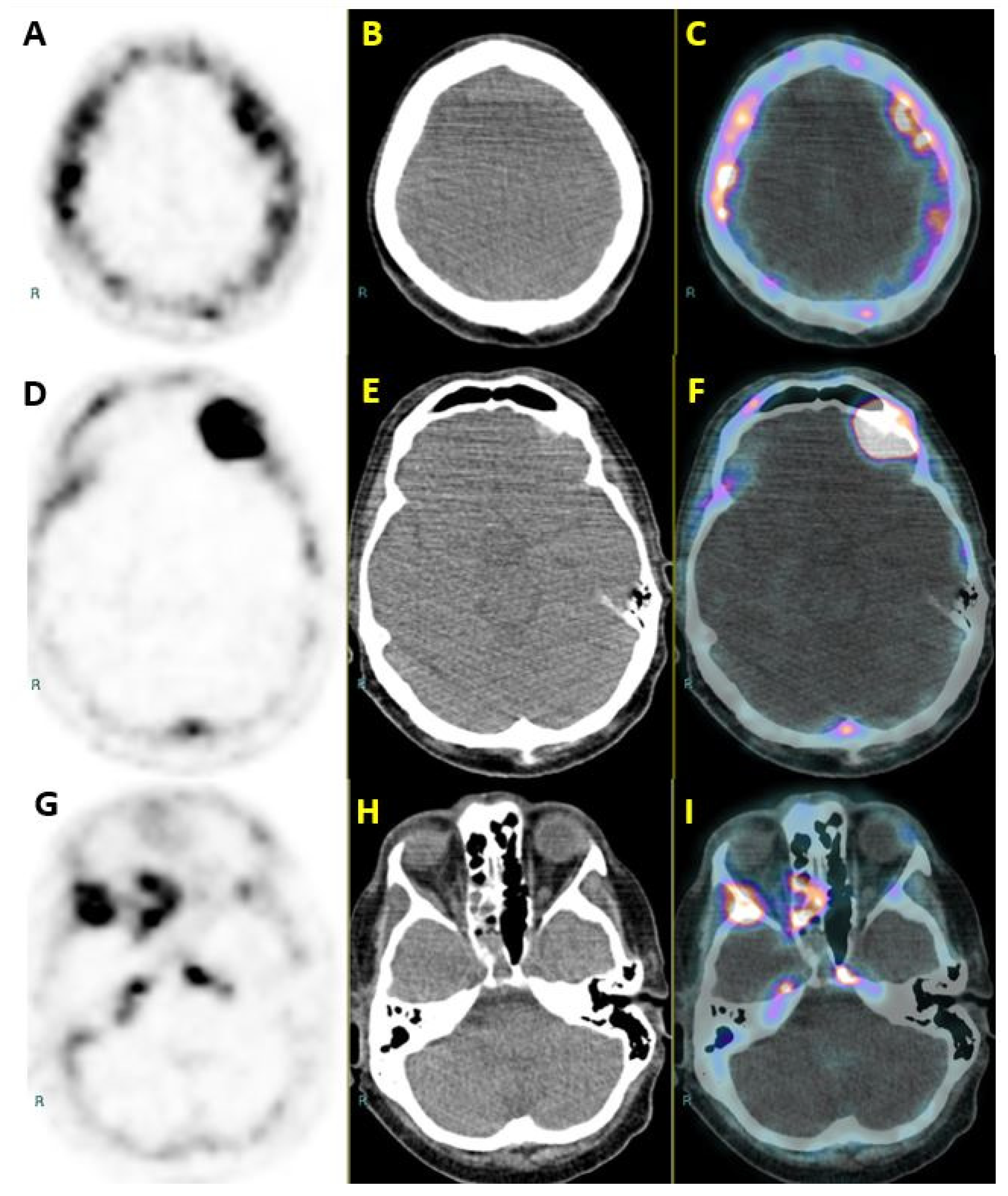 cancer prostate metastase forum