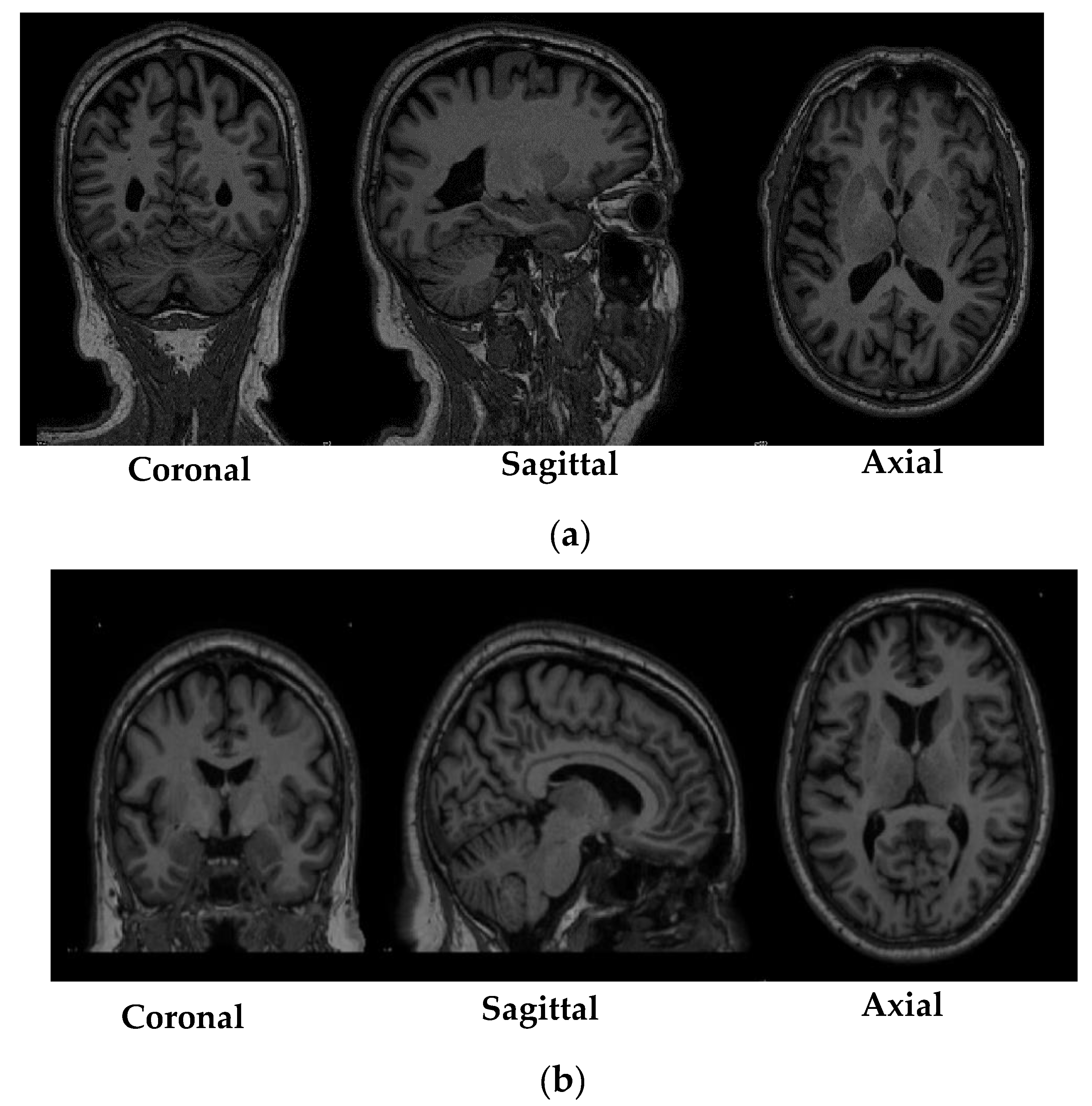 Diagnostics Free FullText Detection of Parkinson’s Disease from 3T T1 Weighted MRI Scans
