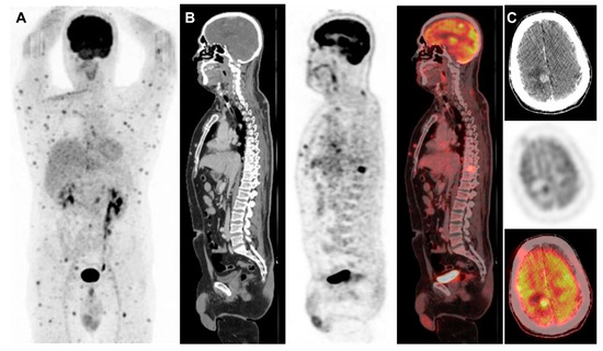 Brain Metastases Unresponsive to Immunotherapy Detected by 18F-FDG-PET ...