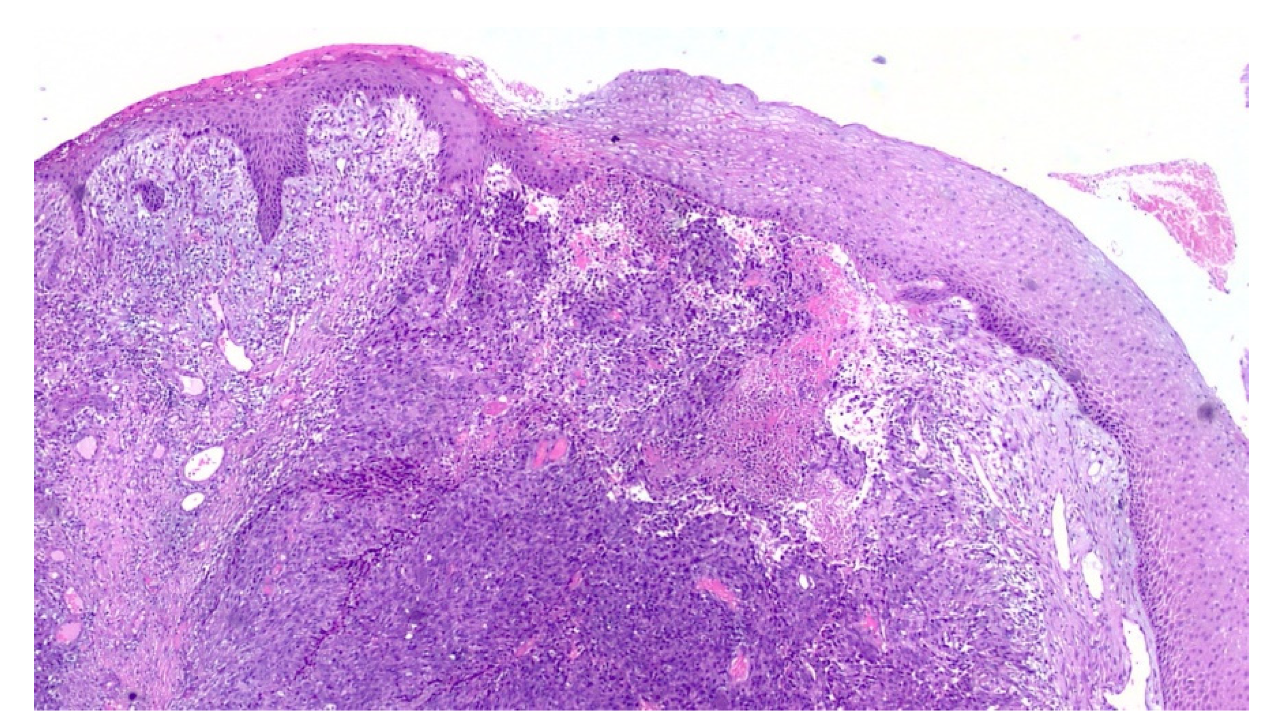 Diagnostics | Free Full-Text | Multifocal Amelanotic Melanoma of the Hard Palate: A Challenging Case Diagnostics | Free Full-Text | Multifocal Amelanotic Melanoma of the Hard Palate: A Challenging Case