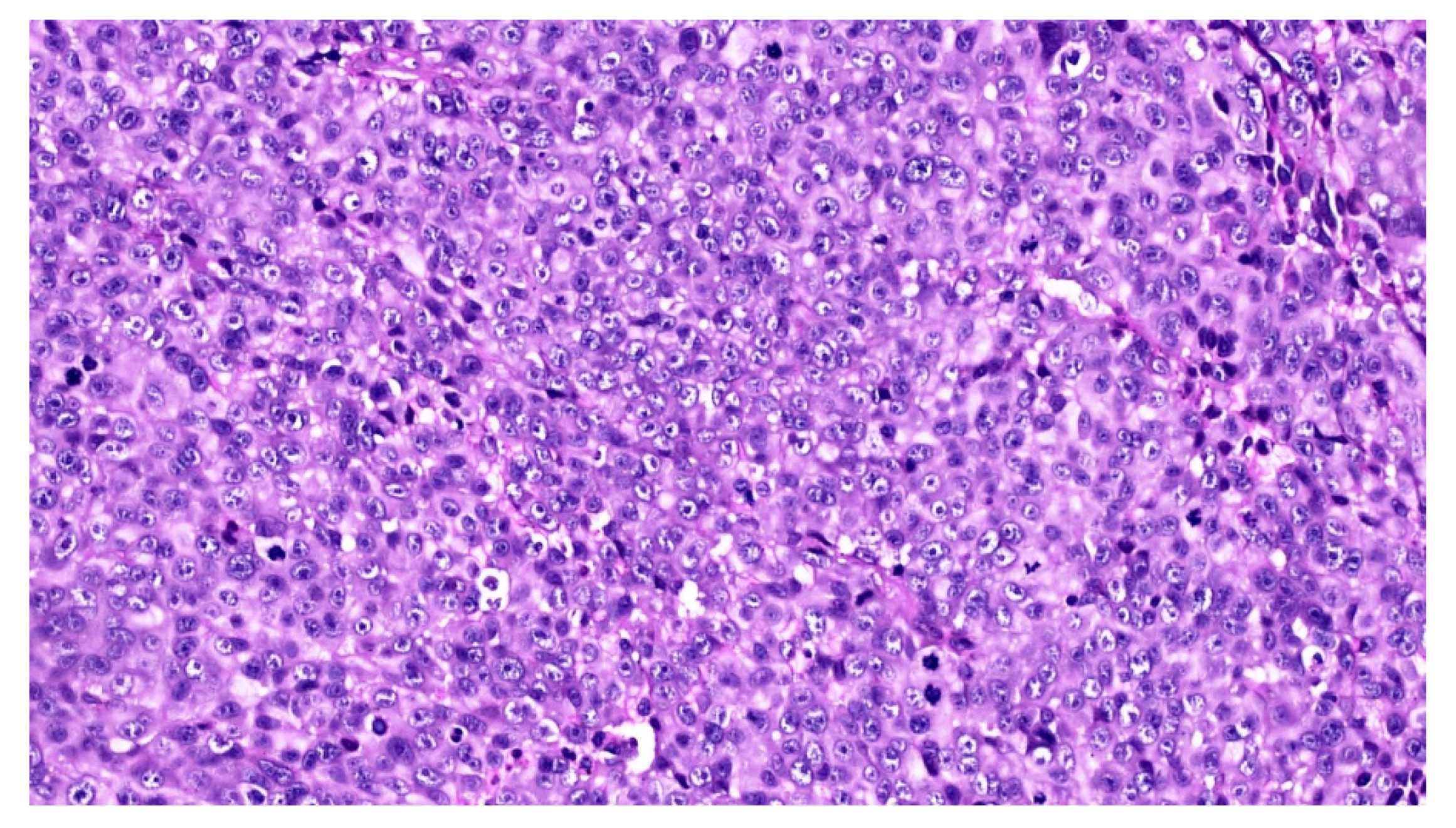 Diagnostics | Free Full-Text | Multifocal Amelanotic Melanoma of the Hard Palate: A Challenging Case Diagnostics | Free Full-Text | Multifocal Amelanotic Melanoma of the Hard Palate: A Challenging Case