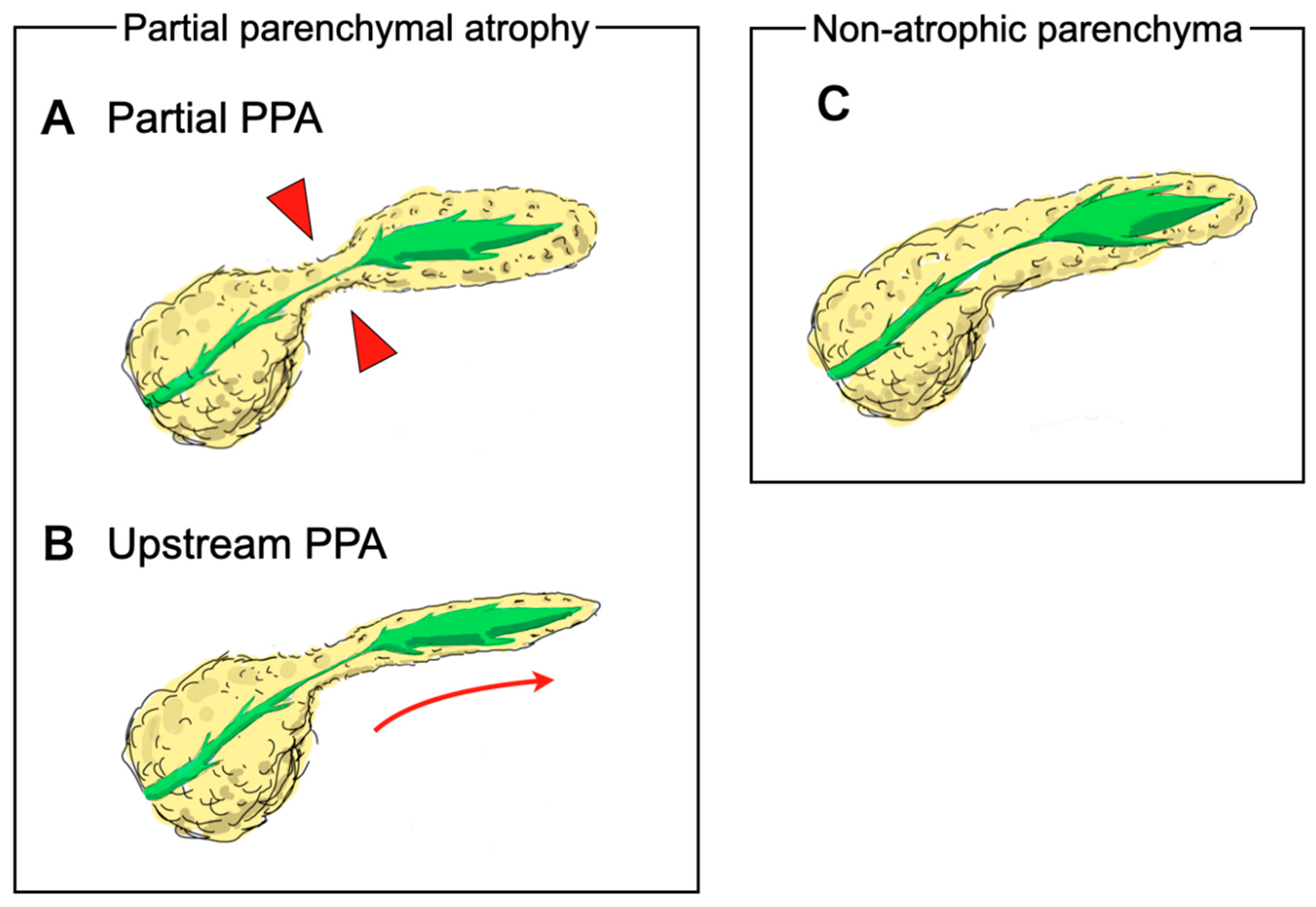 Parenchymal Atrophy parenchymal-atrophy