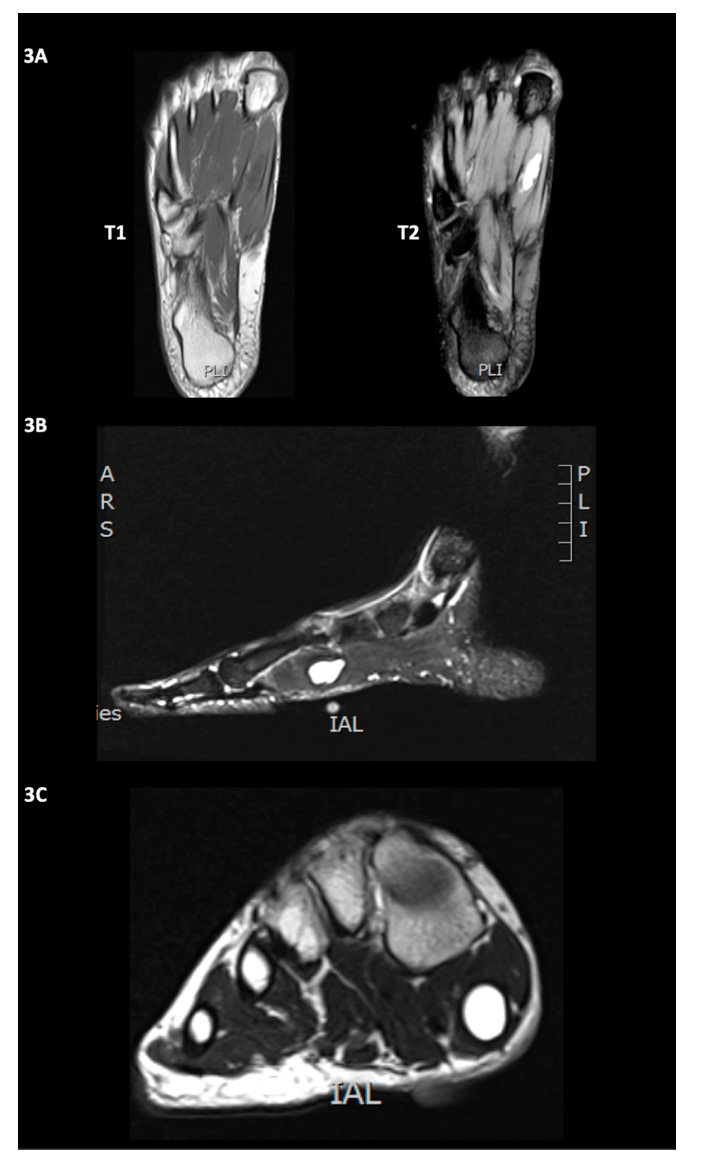 Diagnostics Free Full Text Intramuscular Ganglion Cyst Of The Flexor Hallucis Brevis Secondary To Muscle Tear A Case Report Html