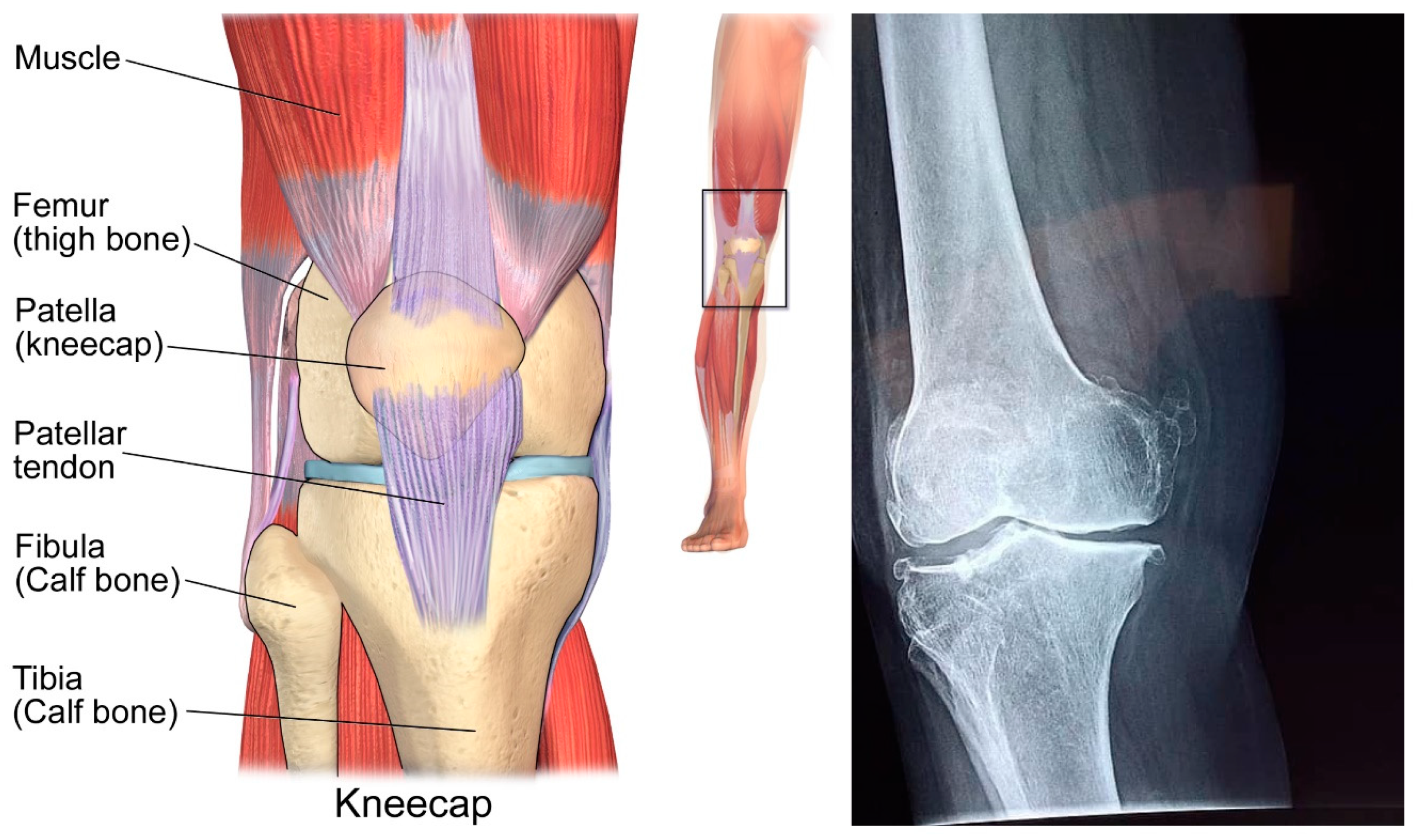 femur anatomy xray