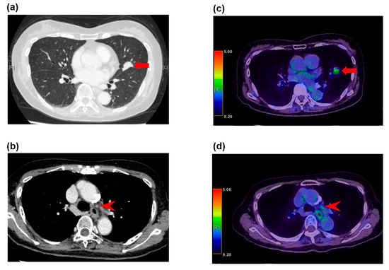 Ct Metastatic Lung Cancer