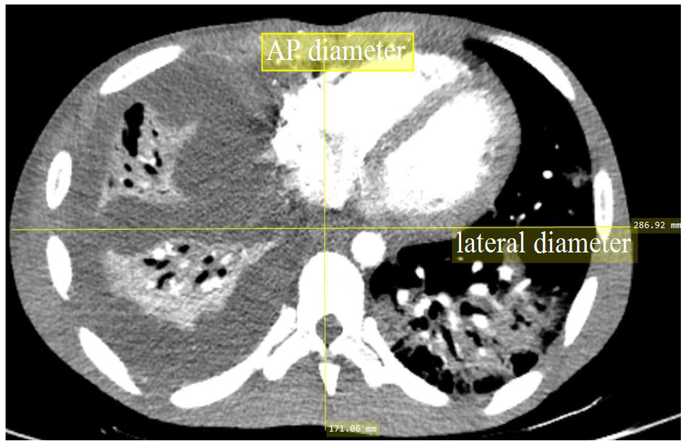 Diagnostics Free Full Text Association Of Radiation Doses And Cancer Risks From Ct Pulmonary Angiography Examinations In Relation To Body Diameter Html Diagnostics Free Full Text Association Of Radiation Doses And Cancer Risks From Ct Pulmonary Angiography Examinations In Relation To Body Diameter Html