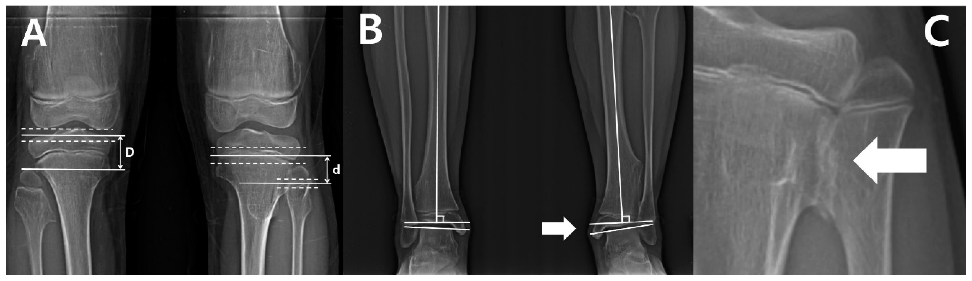 Diagnostics Free Full Text Longitudinal Observation Of Changes In The Ankle Alignment And Tibiofibular Relationships In Hereditary Multiple Exostoses Html