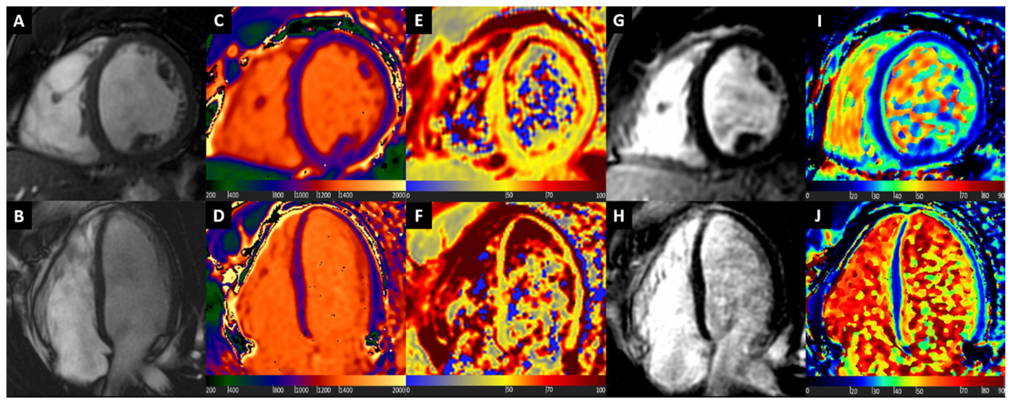 ASDAS states in patients stratified by baseline MRI/CRP status.