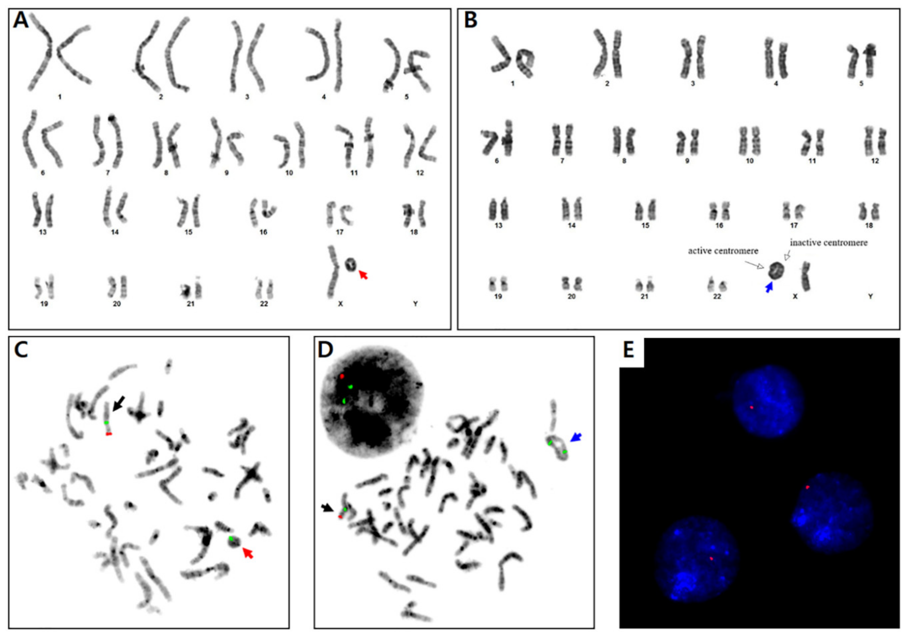 e (A) Karyotype of child showing Trisomy 21. (B) Karyotype of child... |  Download Scientific Diagram