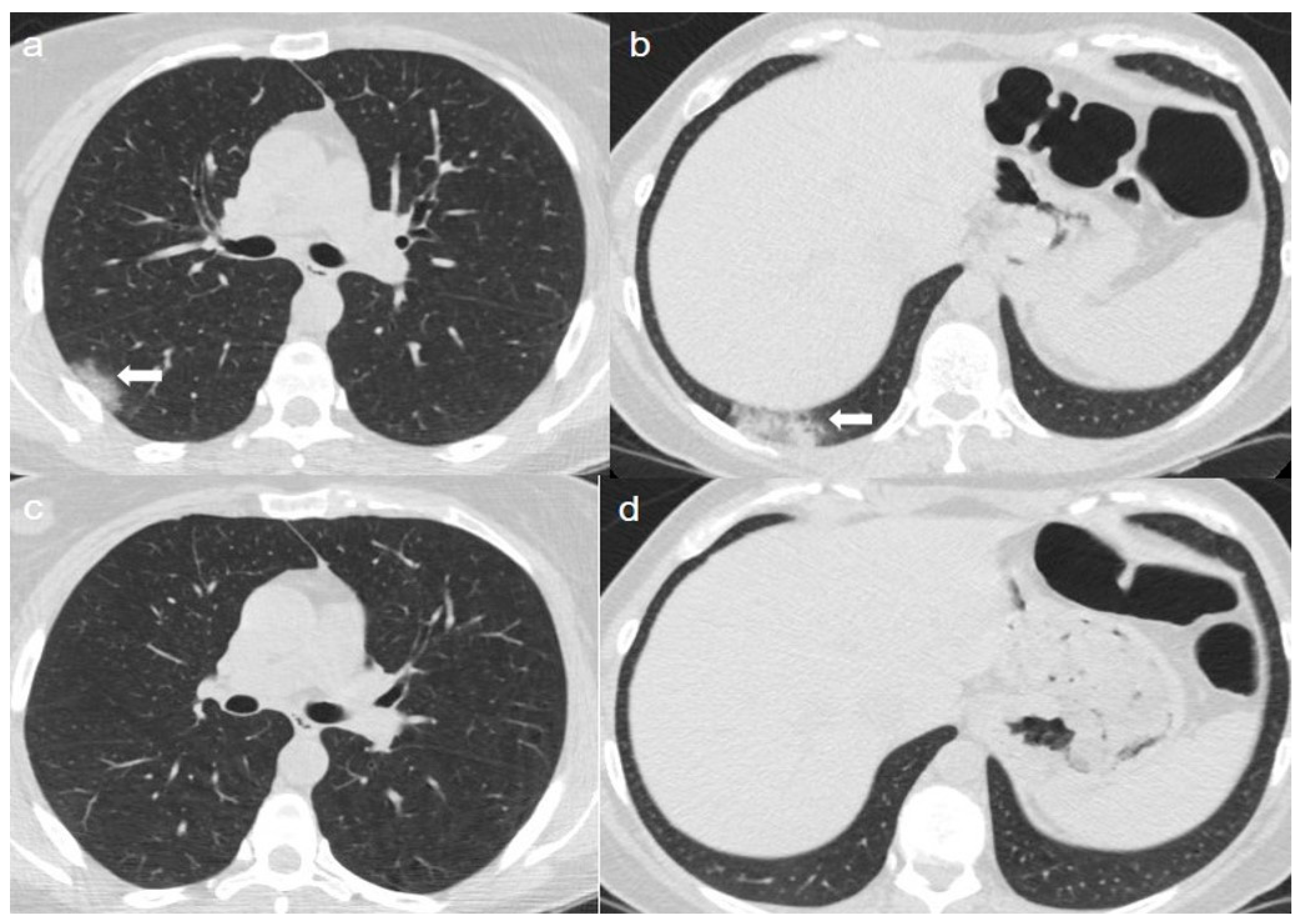 Diagnostics Free FullText Chest CT Findings after 4 Months from