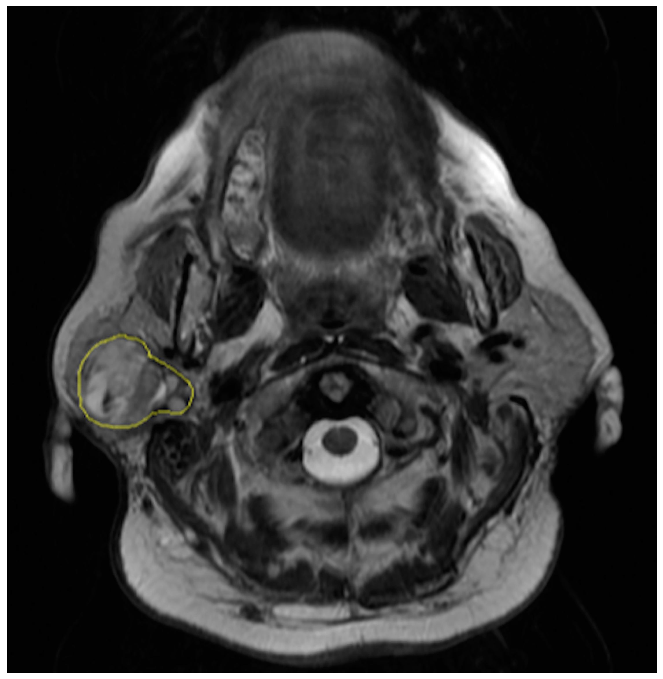 parotid gland tumor ultrasound