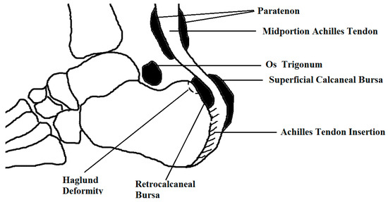 Achilles Tendinopathy and Achilles tendon partial and full thickness  rupture – Caring Medical Florida