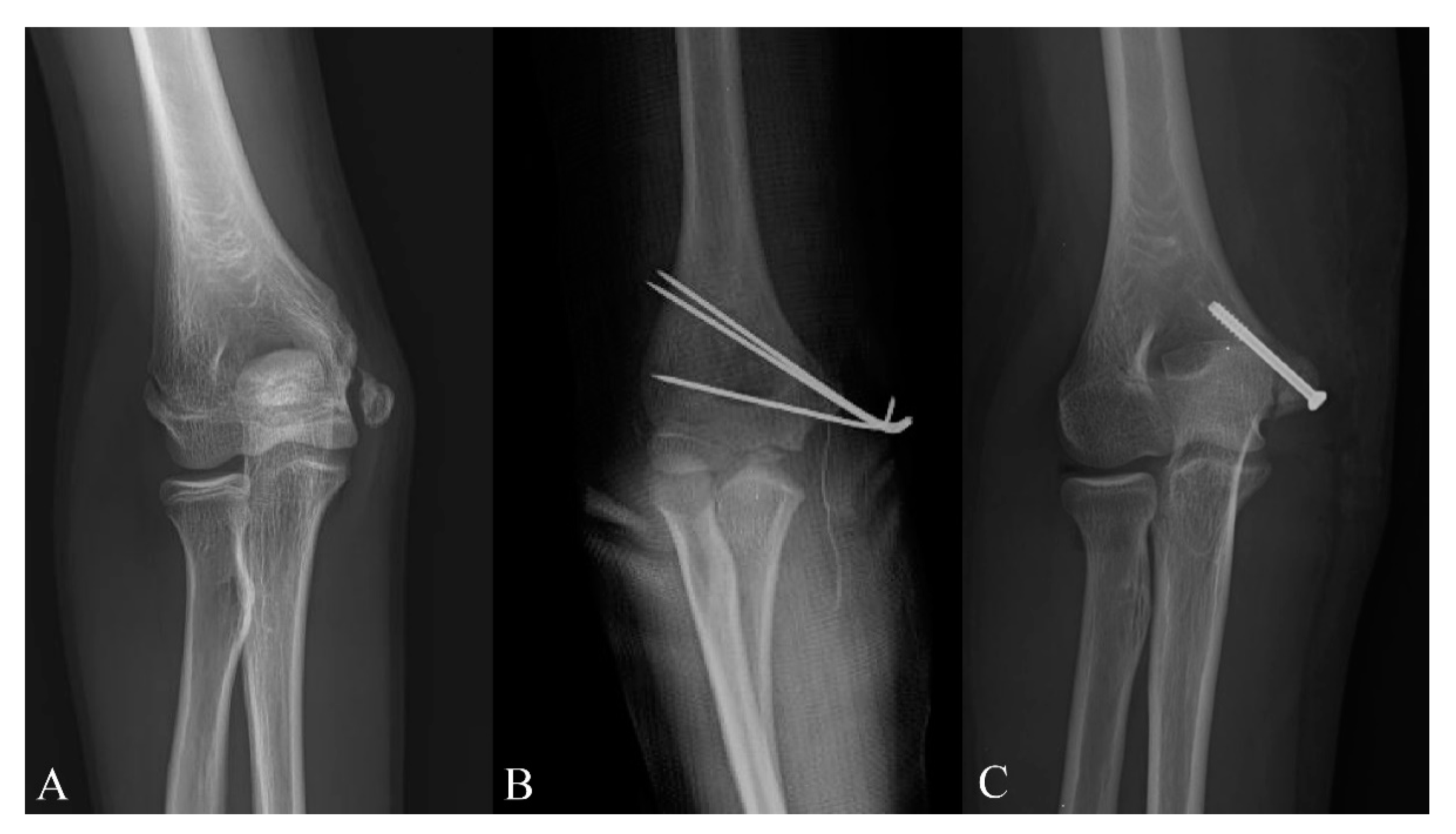 Diagnostics Free Full Text Is Computed Tomography Necessary For Diagnostic Workup In Displaced Pediatric Medial Epicondyle Fractures Html
